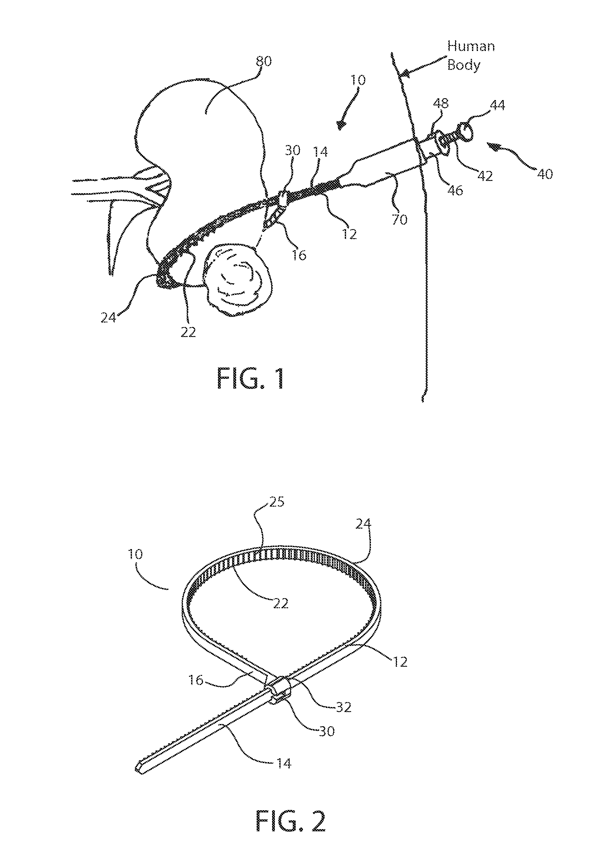 Surgical clamp and method of clamping an organ