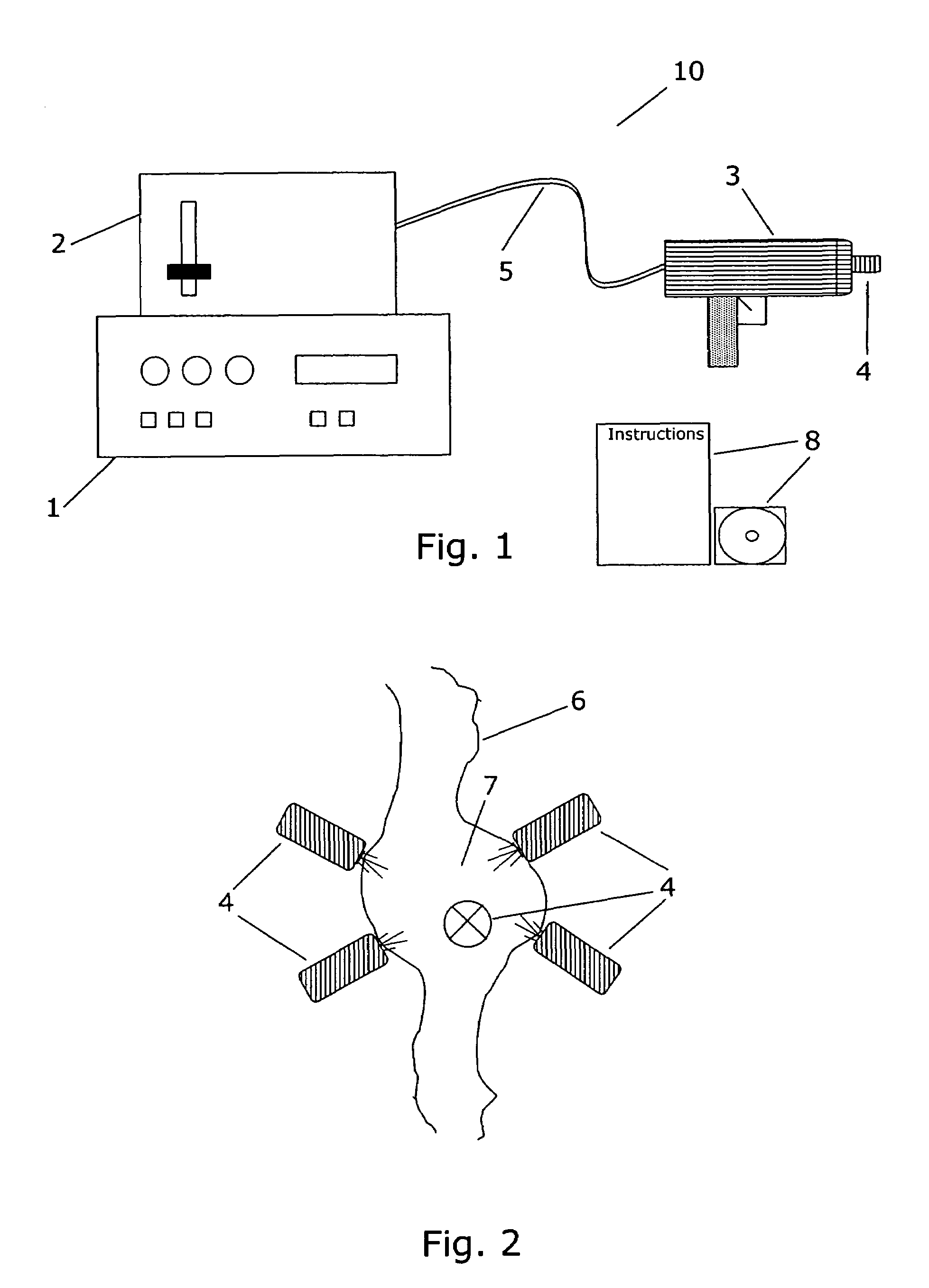 Non-invasive laser treatment of large varices