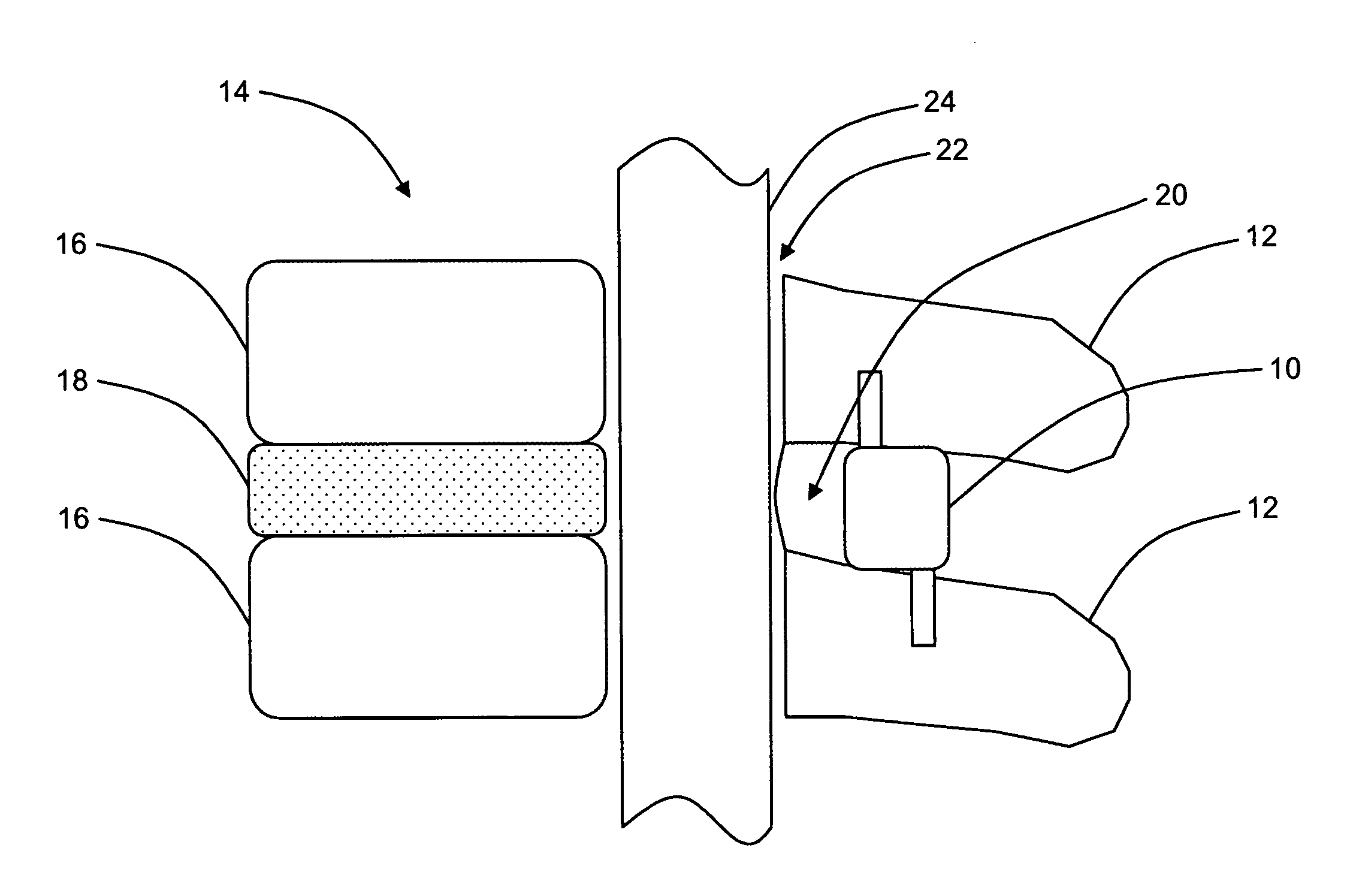 Interspinous distraction devices and associated methods of insertion