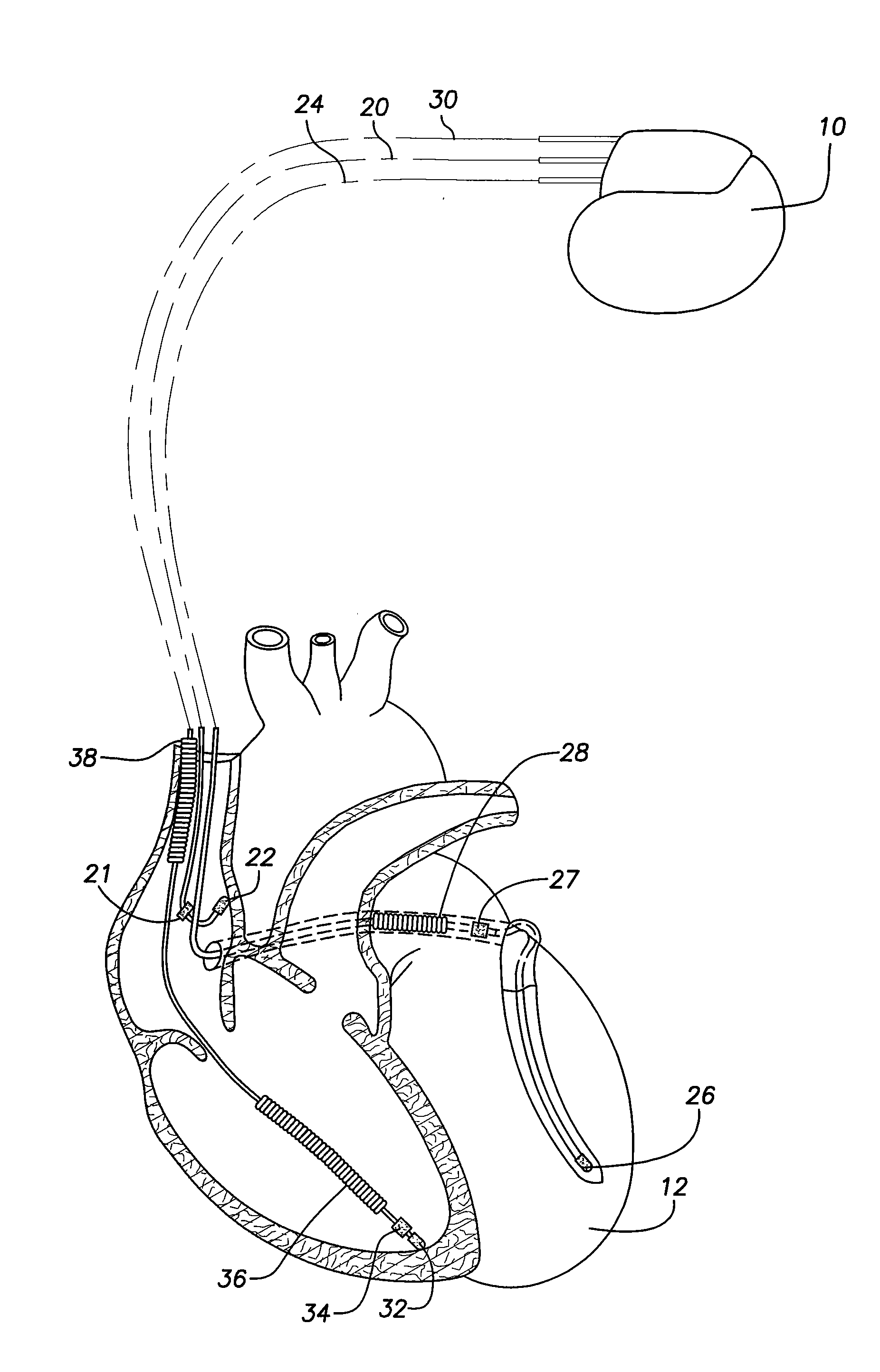 Implantable cardiac device providing intrinsic conduction search with premature atrial contraction protection and method