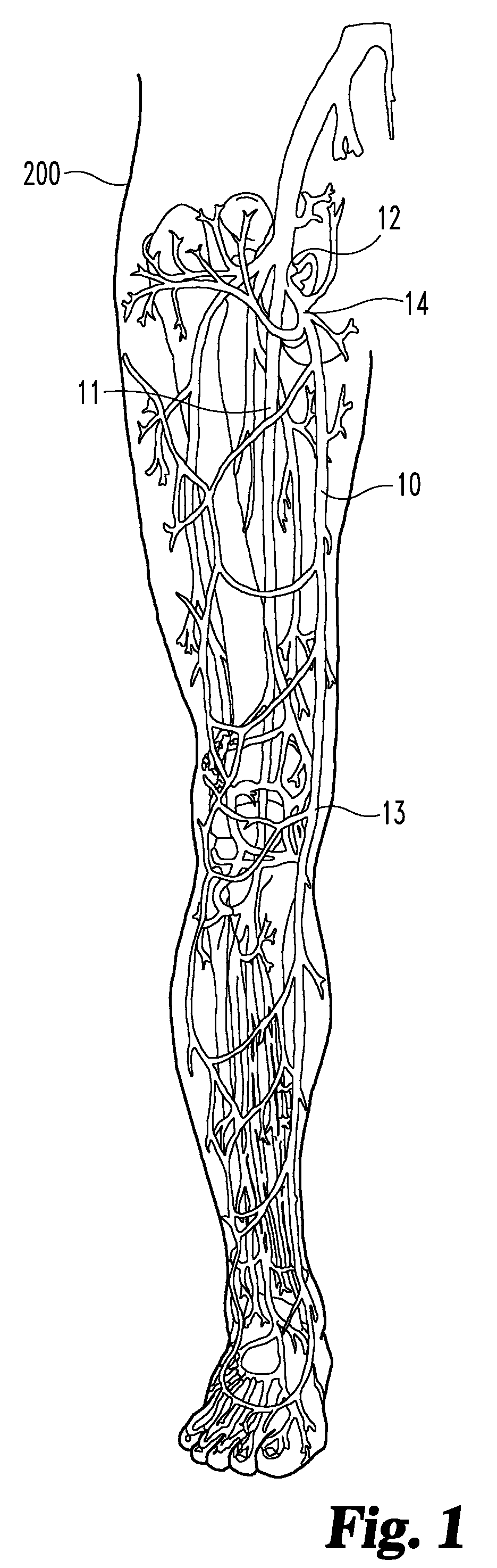 Enhanced remodelable materials for occluding bodily vessels