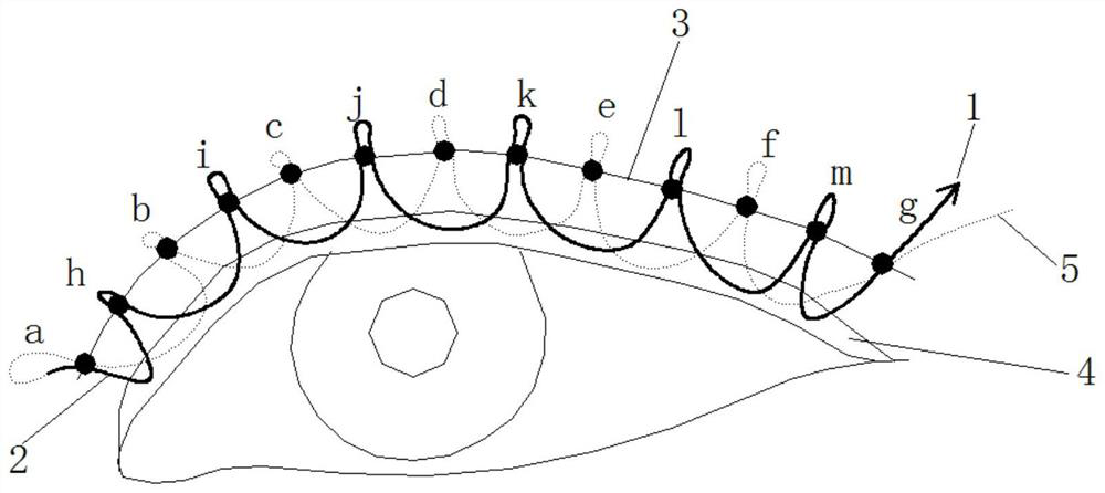 Continuous line embedding method double-fold eyelid surgery technology