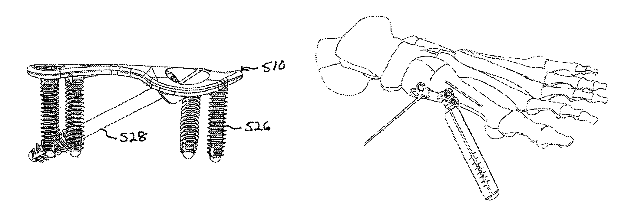 Orthopedic compression plate and method of surgery