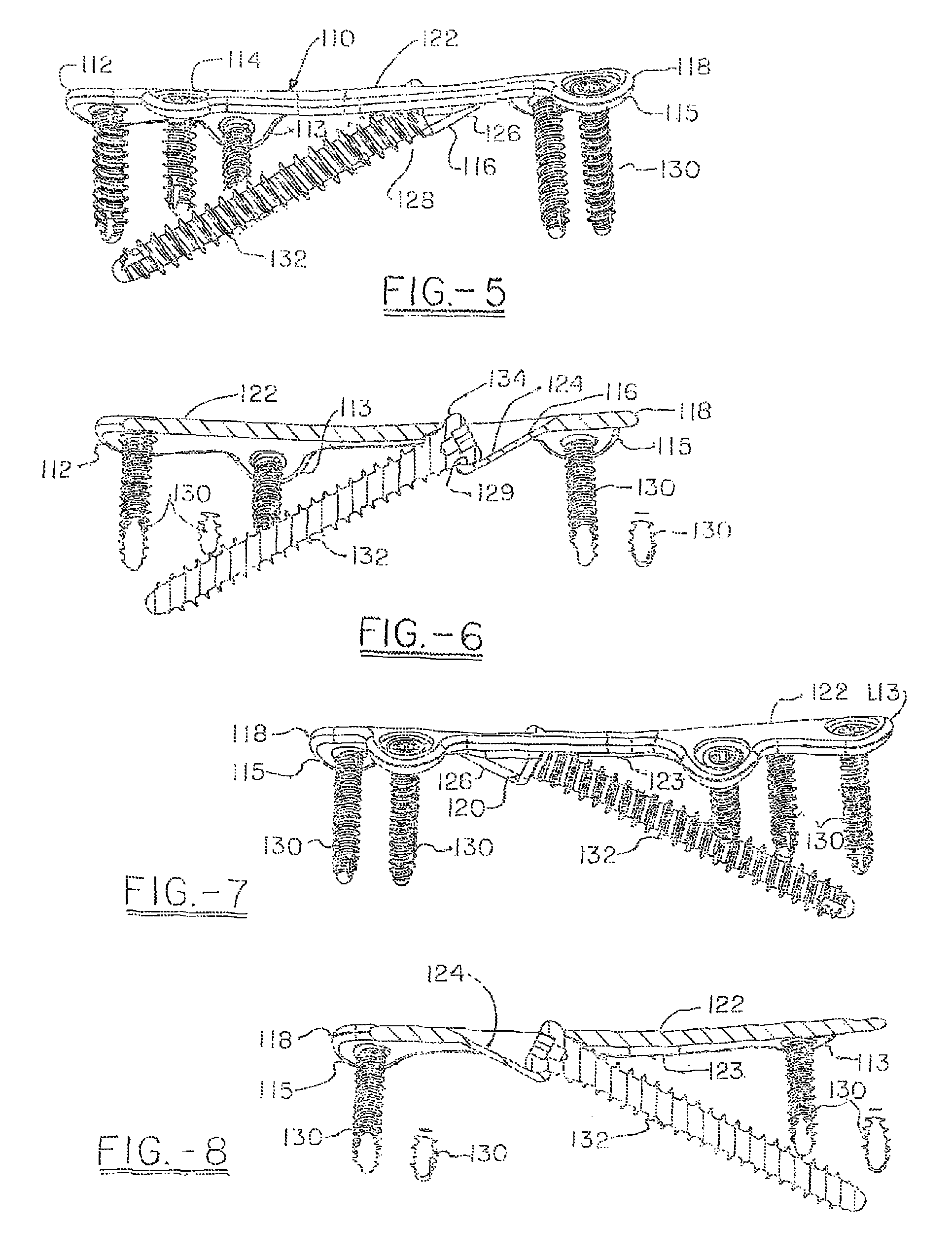 Orthopedic compression plate and method of surgery