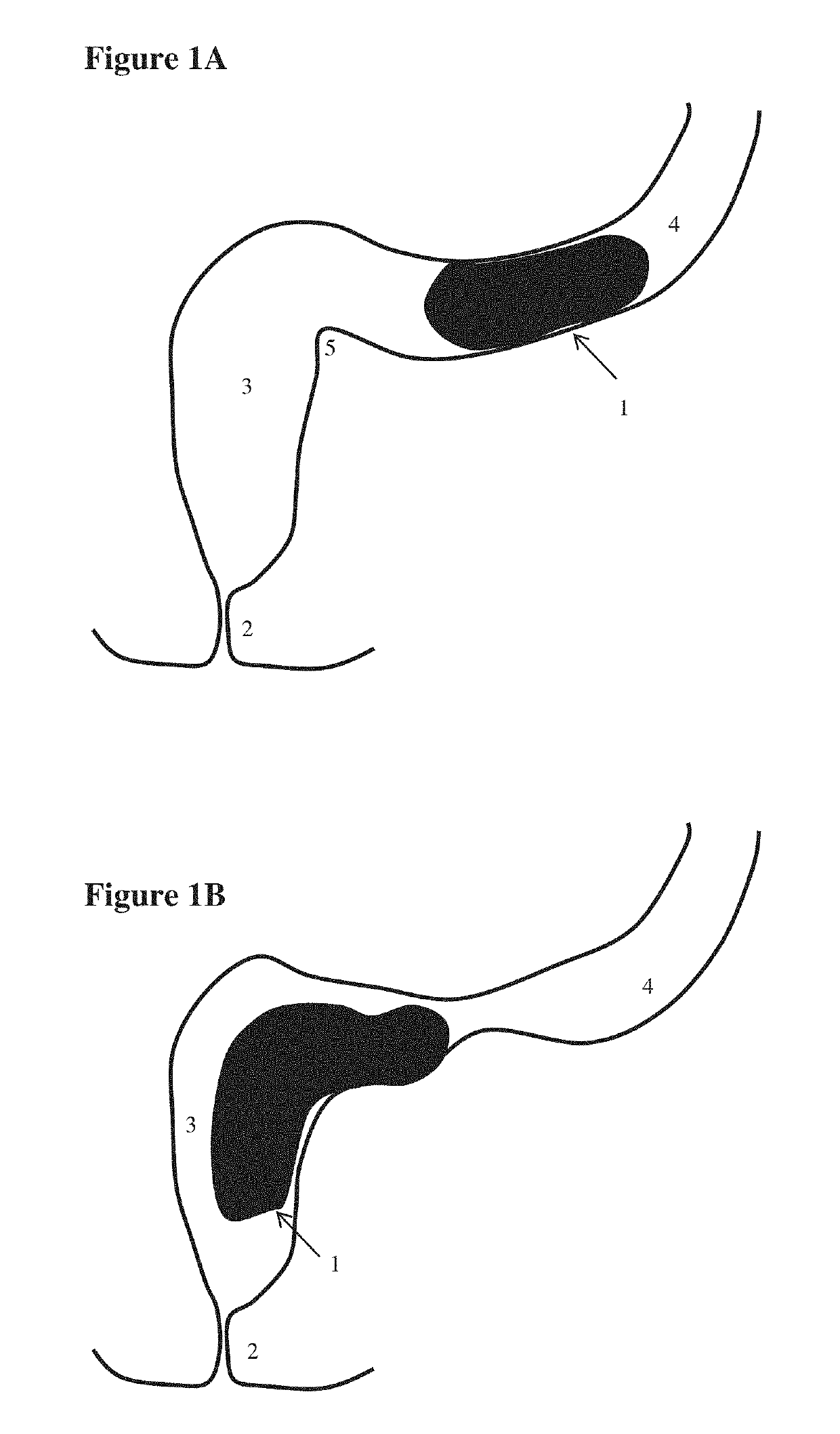 Devices for testing distal colonic and anorectal function