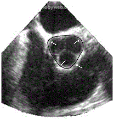 A rapid segmentation method of aortic valve based on esophageal ultrasound