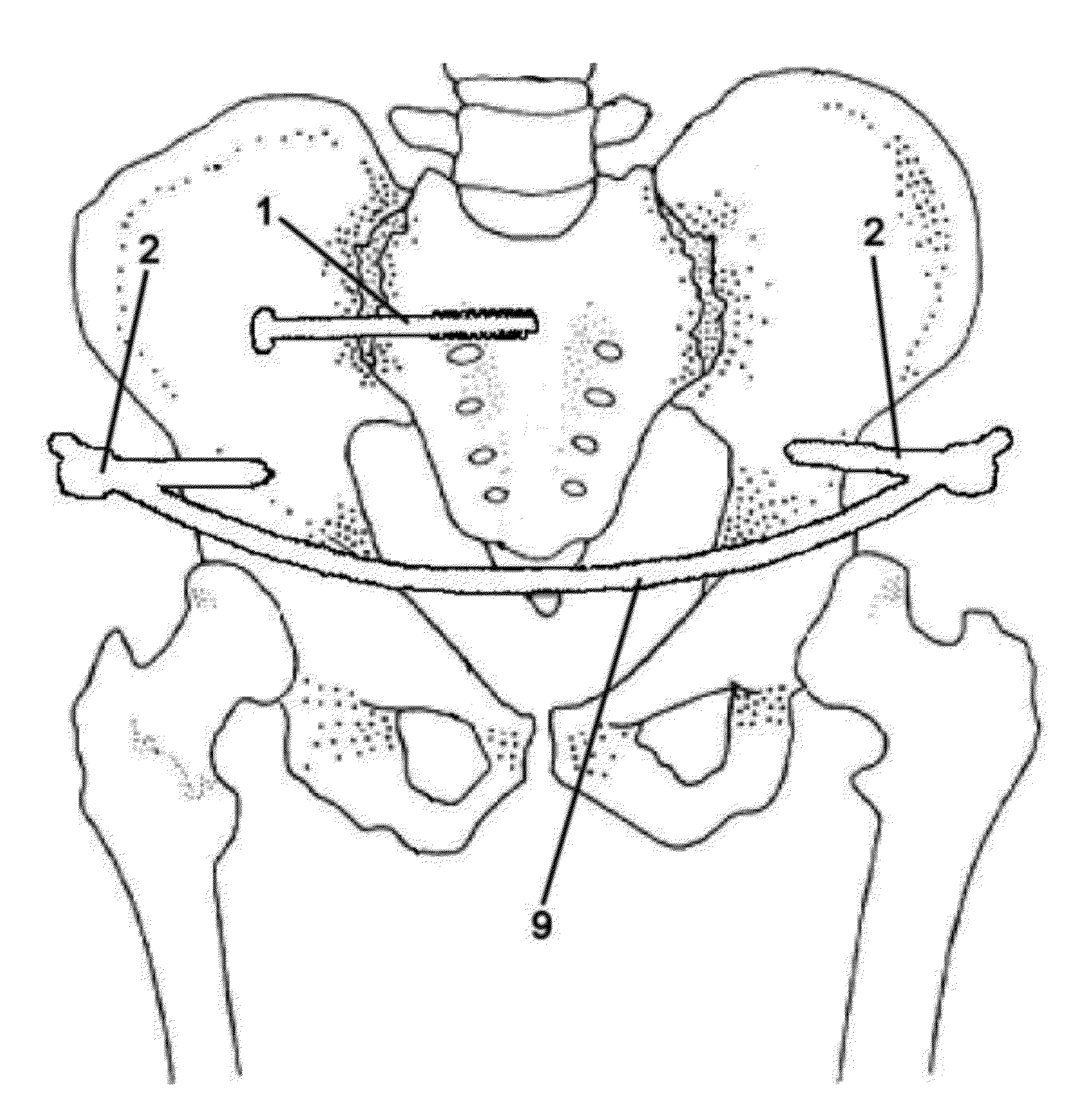 Method for Minimally Invasive Treatment of Unstable Pelvic Ring Injuries