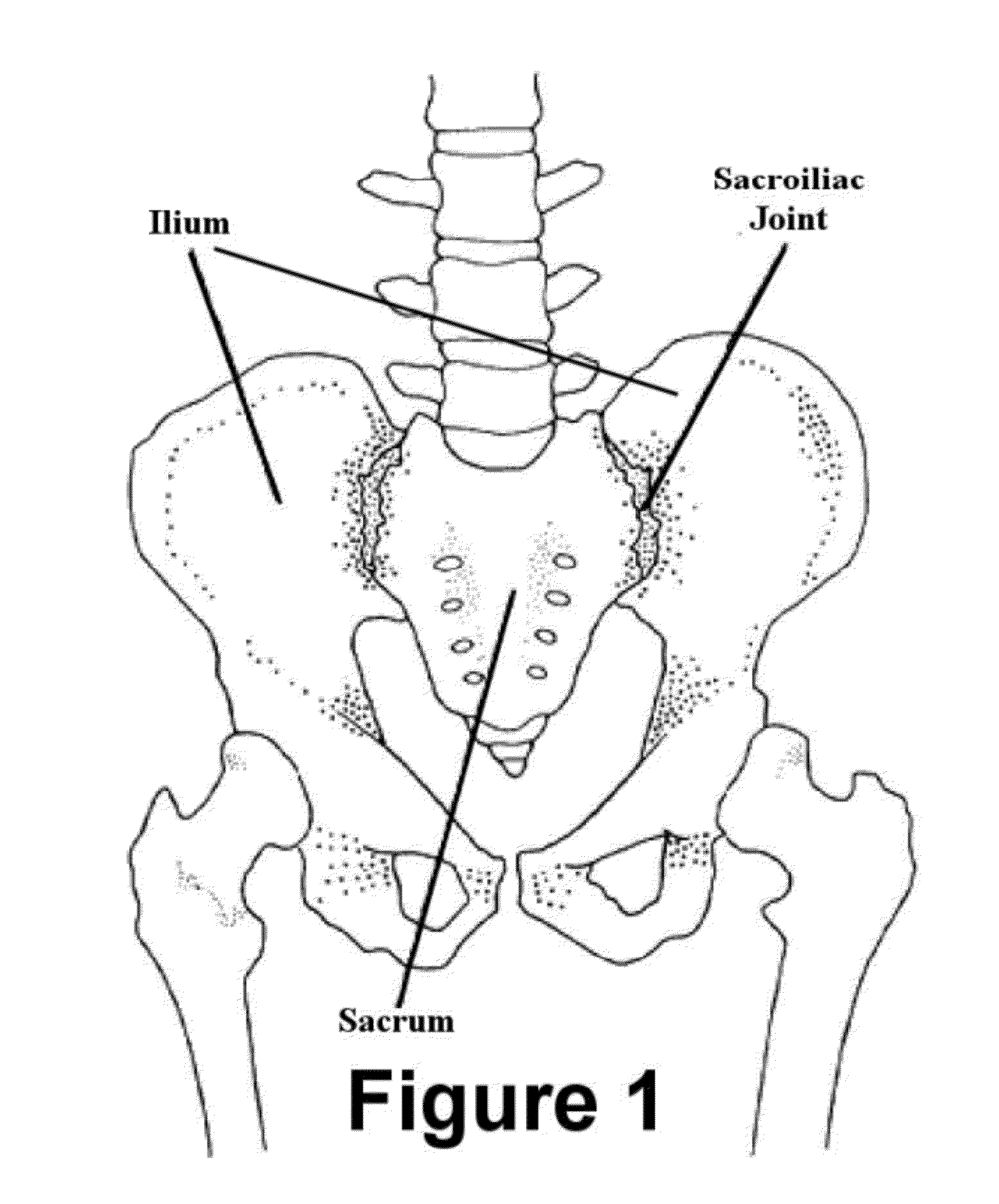 Method for Minimally Invasive Treatment of Unstable Pelvic Ring Injuries