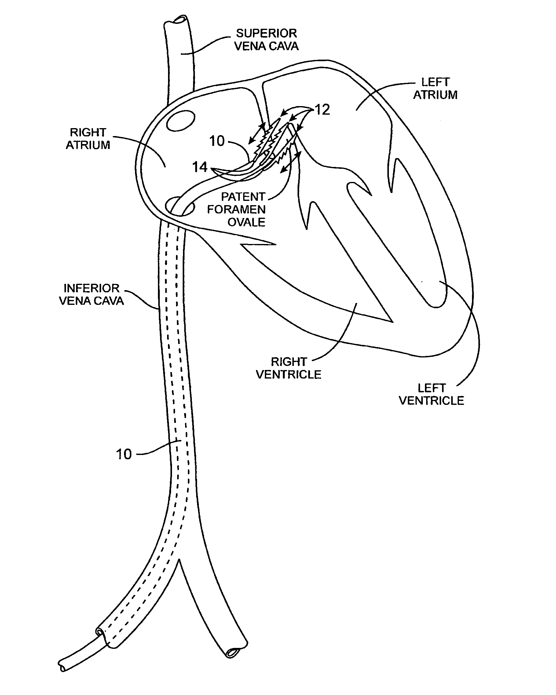 Methods and apparatus for treatment of patent foramen ovale