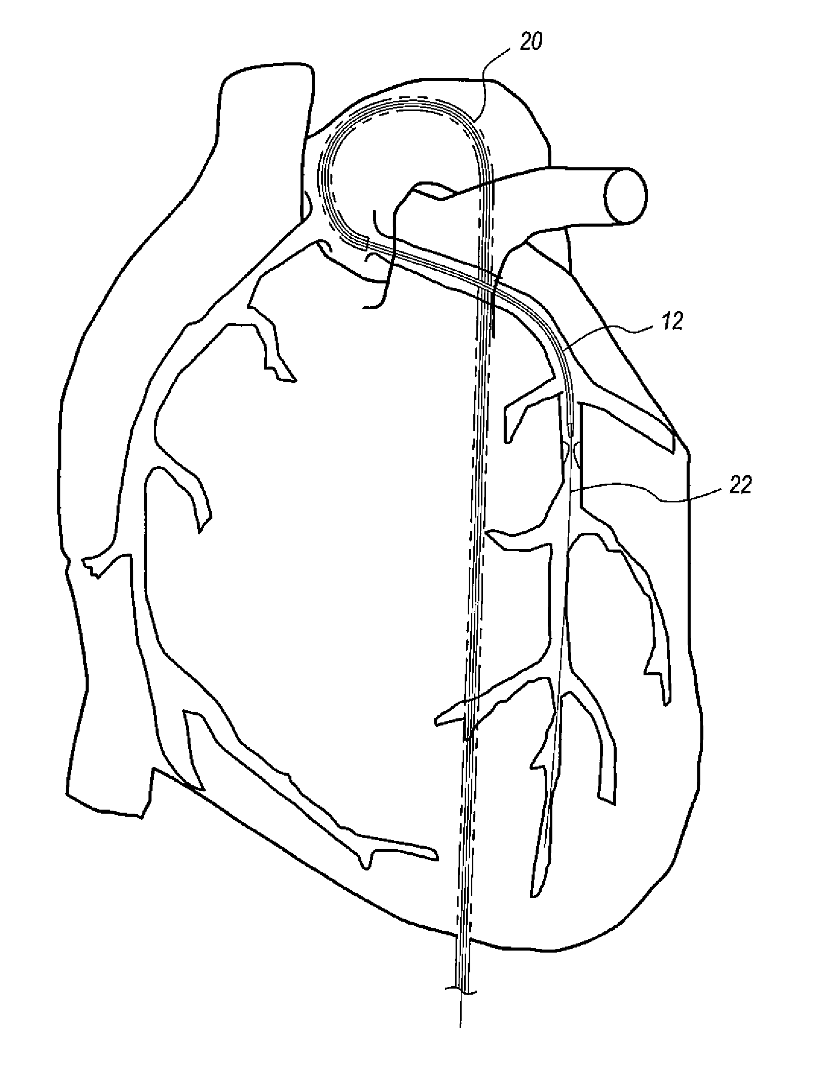 Guide Catheter Extension Device And Methods Of Use For Cardiology ...