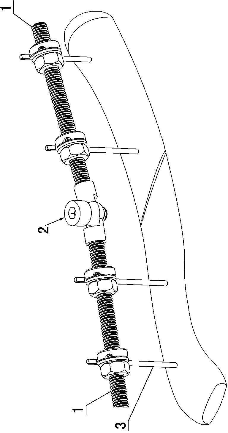 Outer collarbone fixator with locking joint