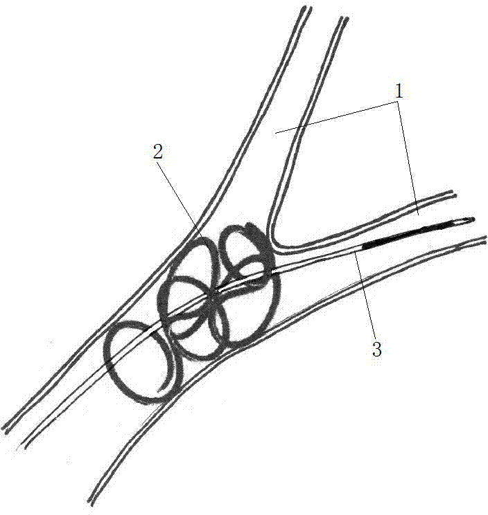 Catching device for foreign matter in blood vessel and catching method thereof