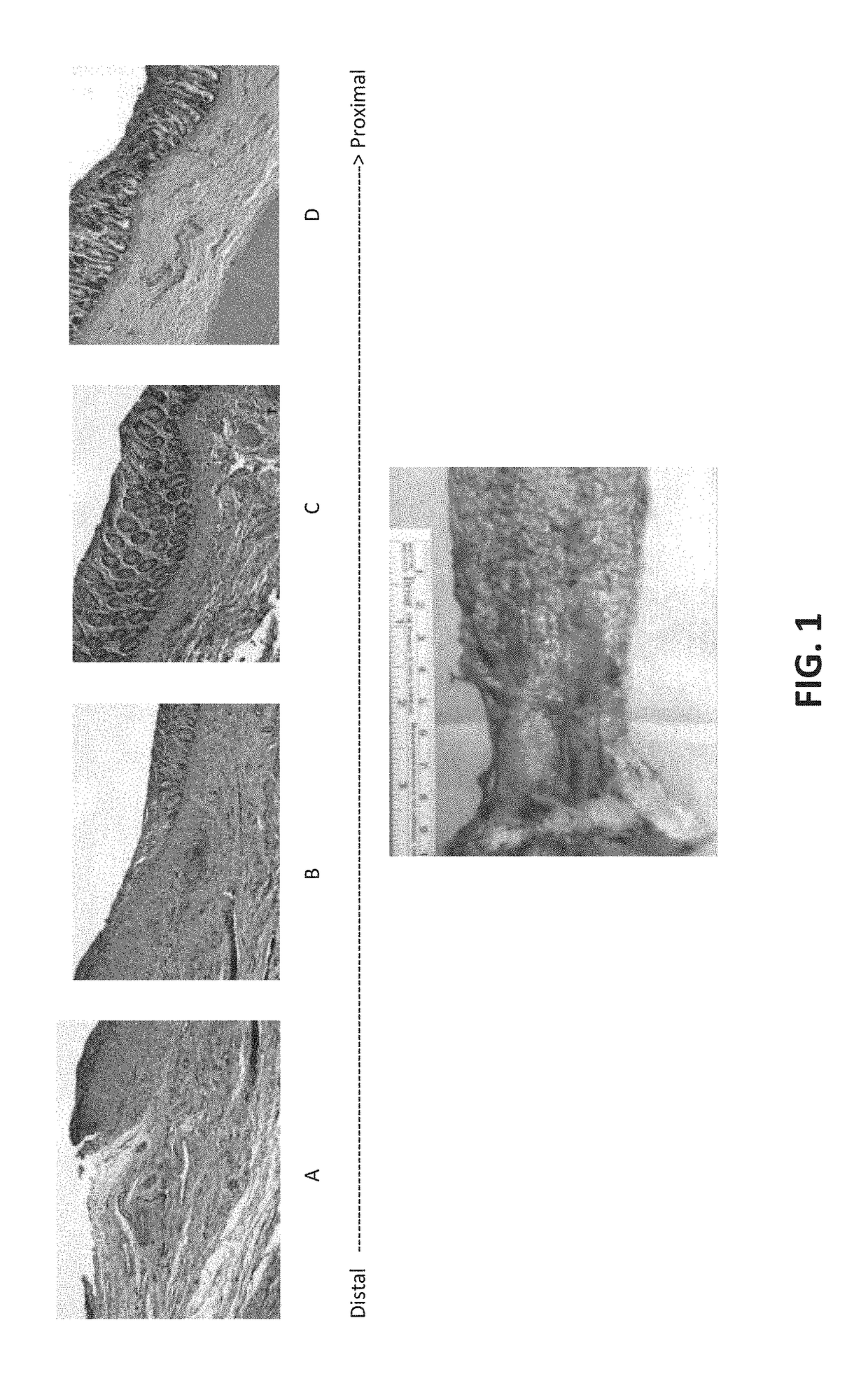 Method and composition for treating inflammatory bowel disease