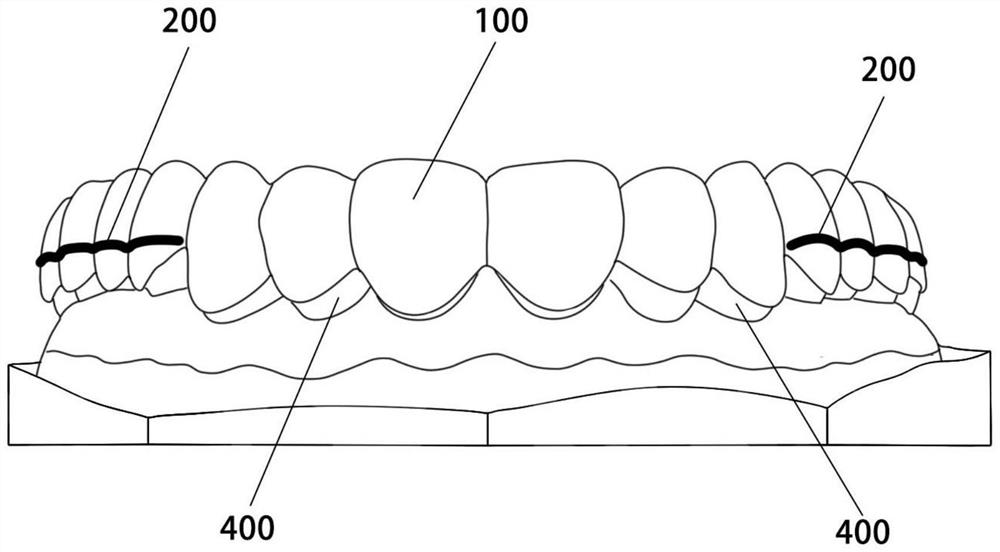 Orthodontic composite appliance, processed semi-finished product and processing method of orthodontic composite appliance