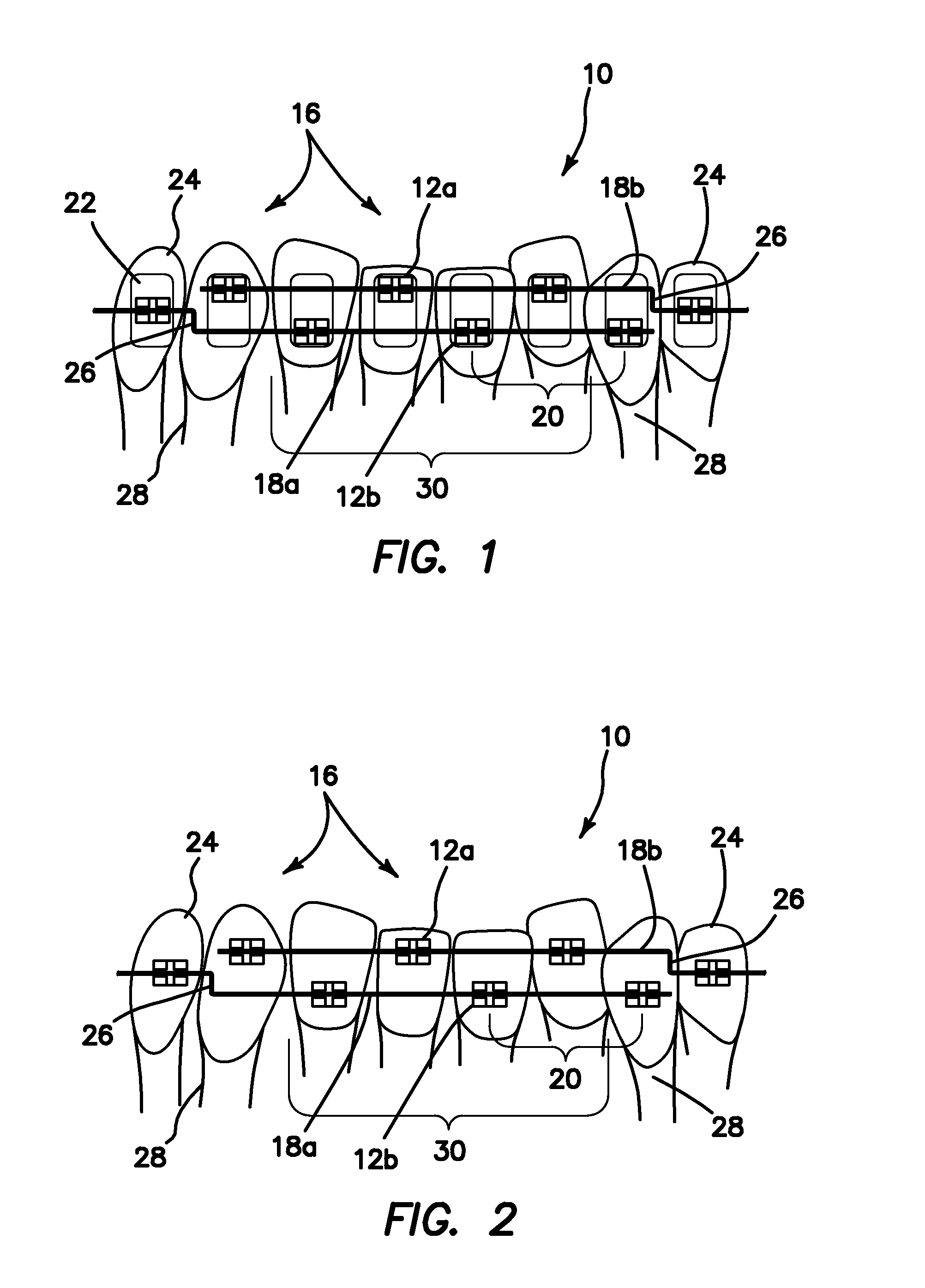 High/low bracket placements on lingual surfaces