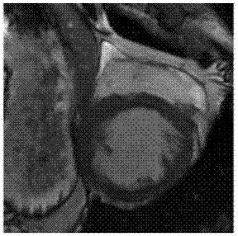 Method for segmenting blood pool in diastasis image in heart cardiac function magnetic resonance image