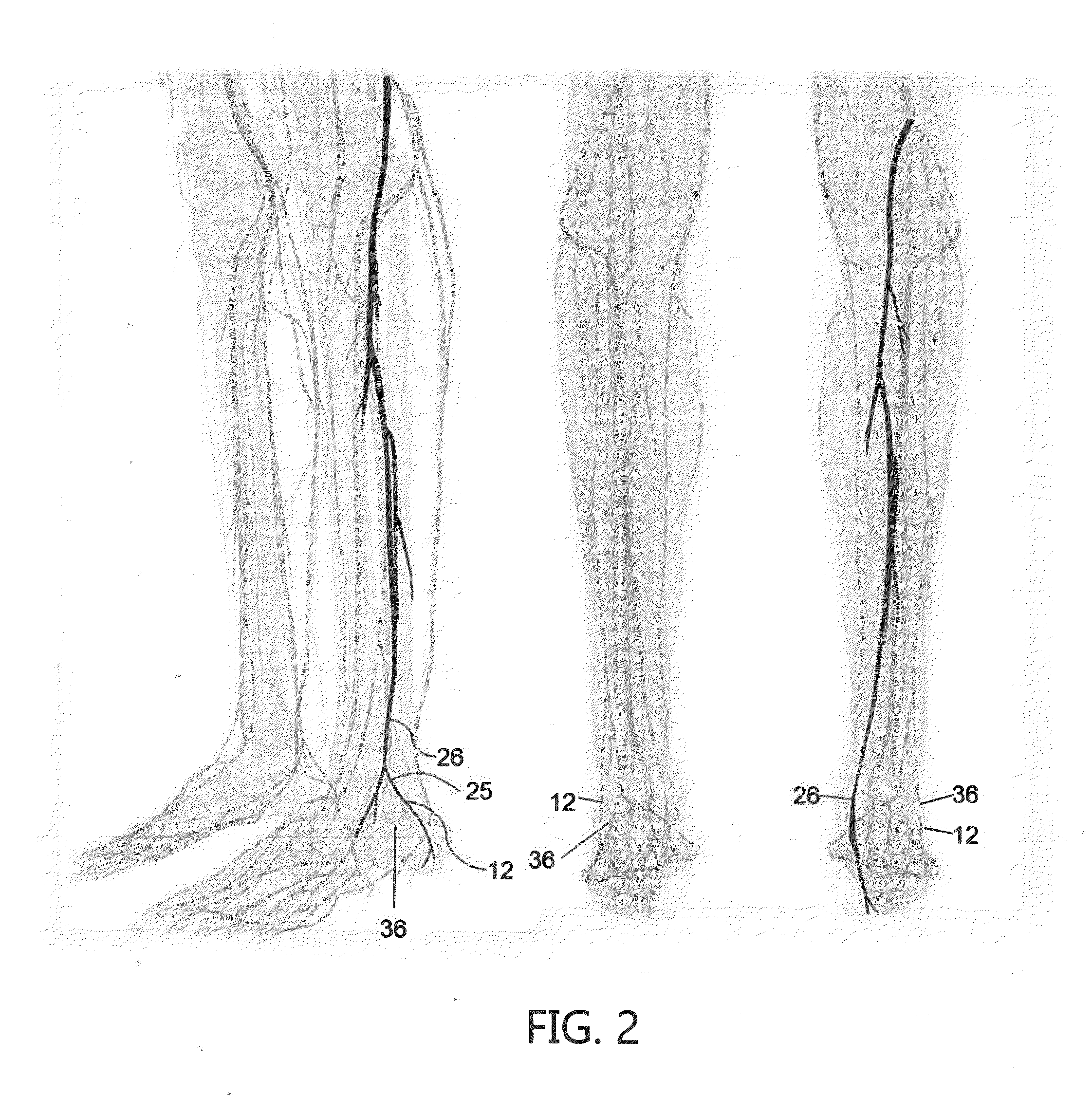 Apparatus for transcutaneous electrical stimulation of the tibial nerve