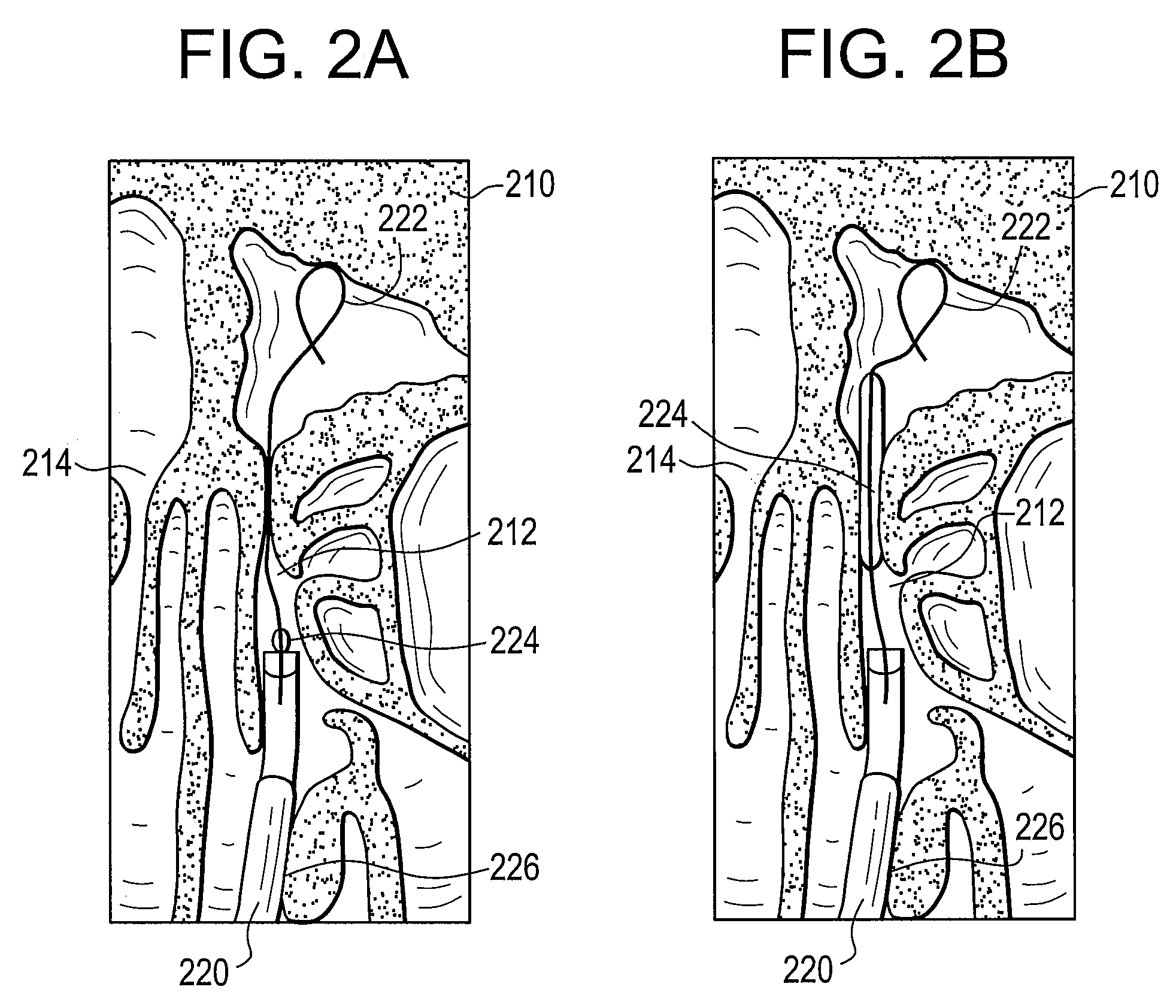 System and Method for Use of Fluoroscope and Computed Tomography Registration for Sinuplasty Navigation