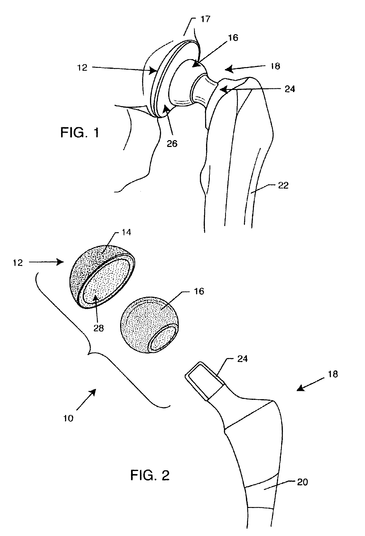 Hip prosthesis with monoblock ceramic acetabular cup