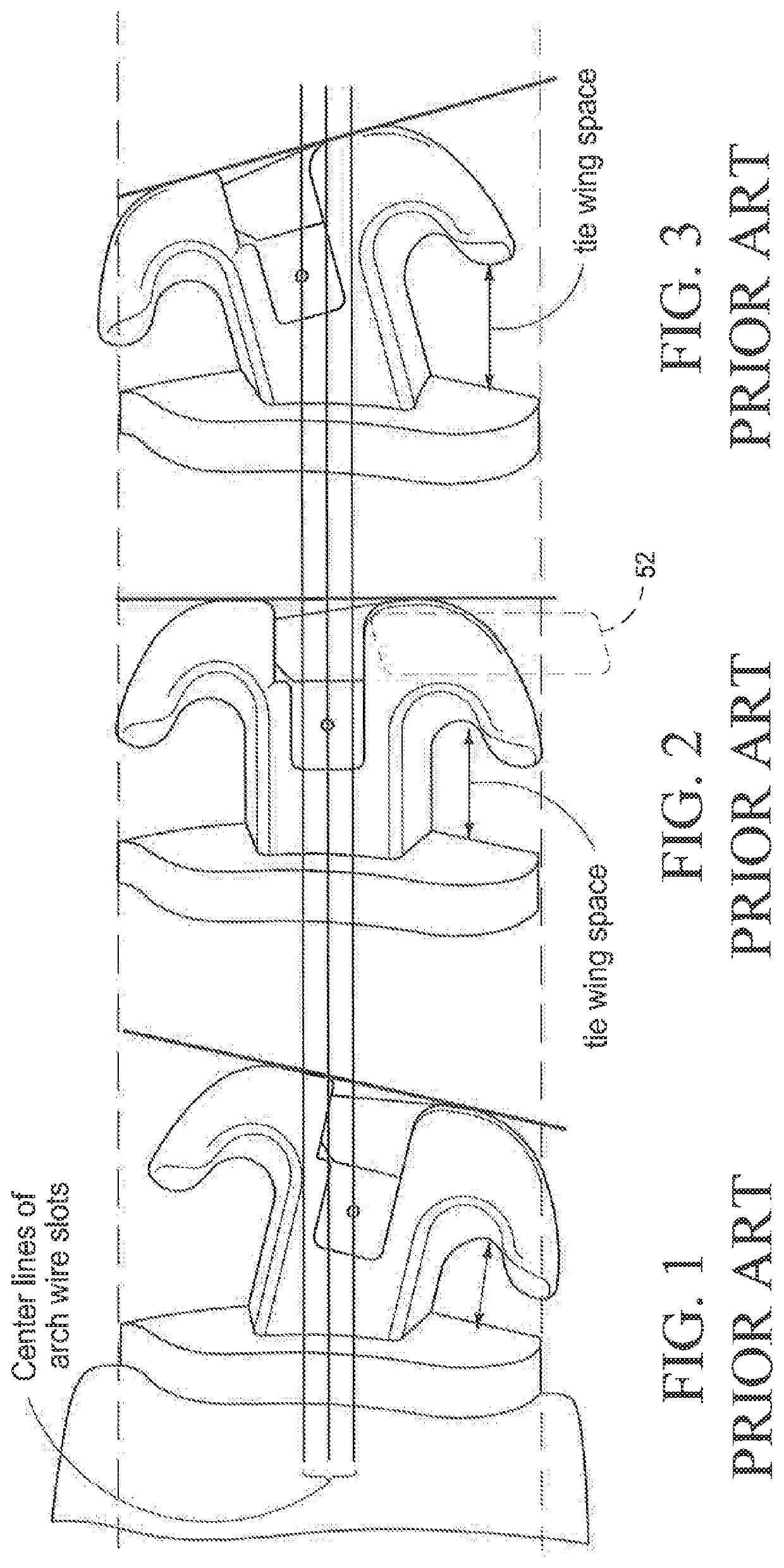 Orthodontic bracket apparatus and method for treating a malocclusion