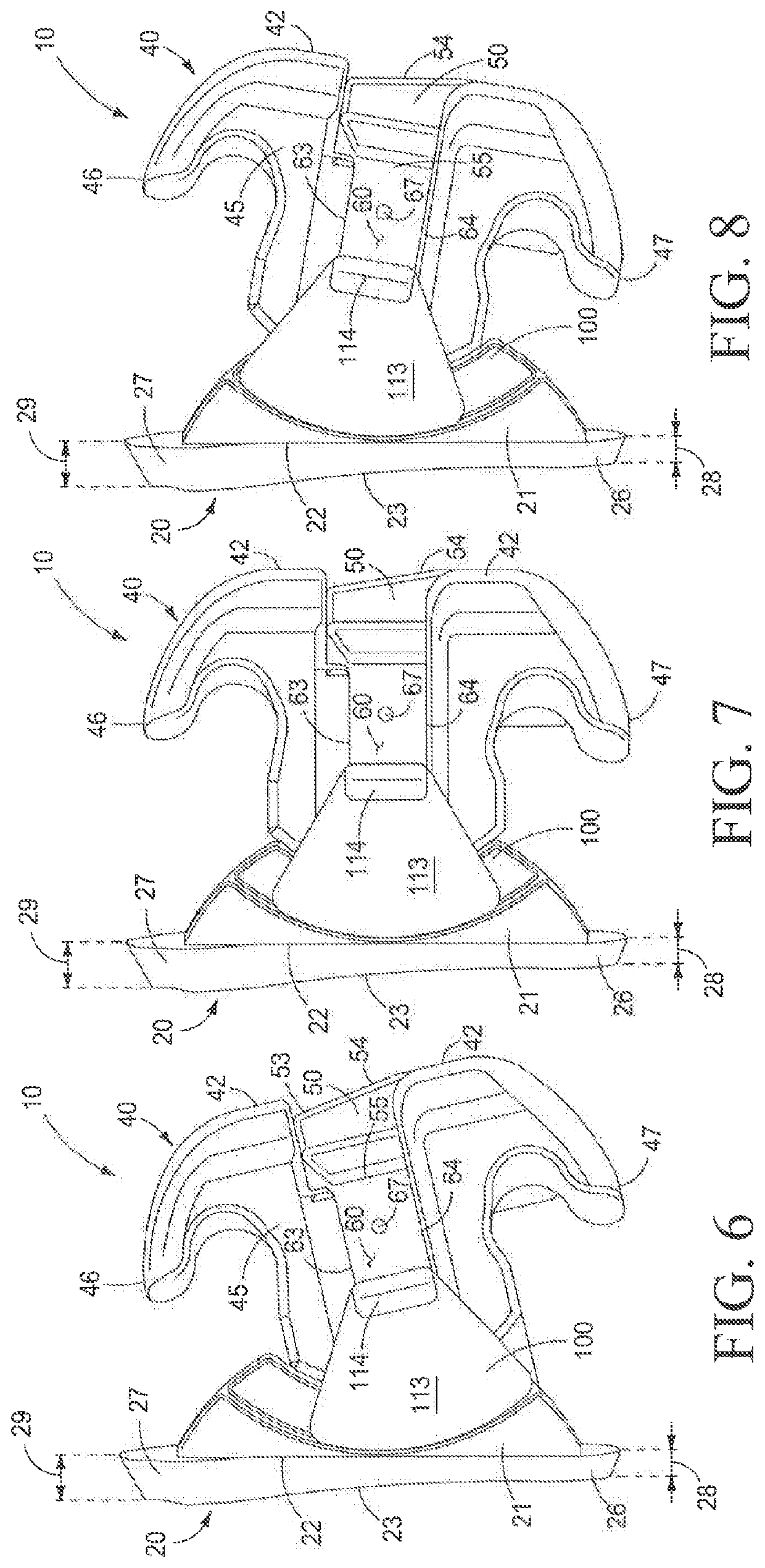 Orthodontic bracket apparatus and method for treating a malocclusion