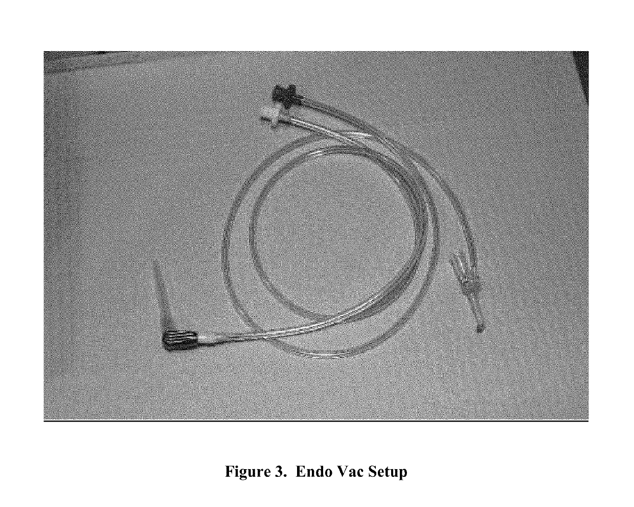 Working Length Confirmation Utilizing Negative Pressure Irrigating Technique And Handpiece