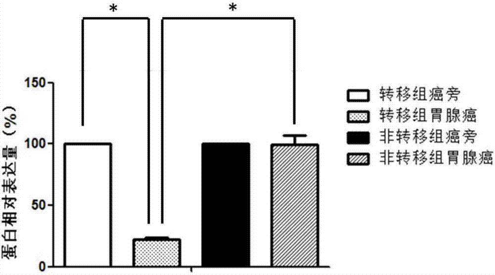 Molecular marker related to gastric adenocarcinoma metastasis