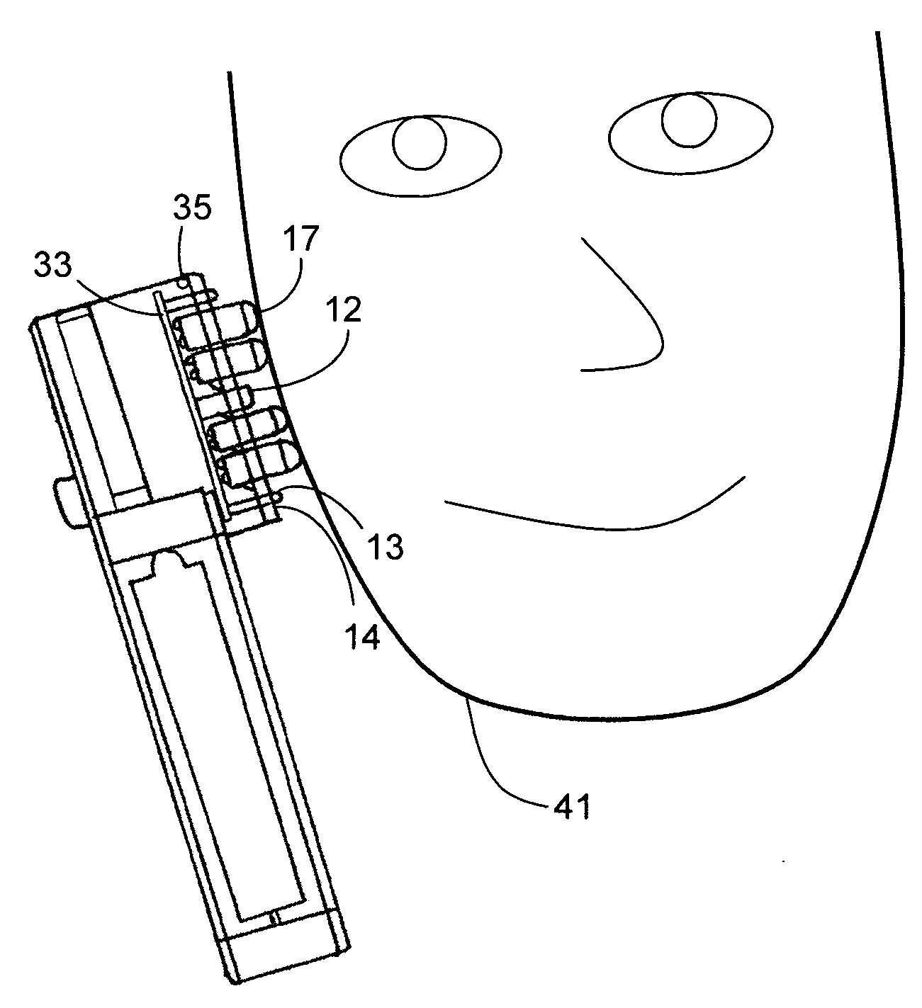 Acne treatment device