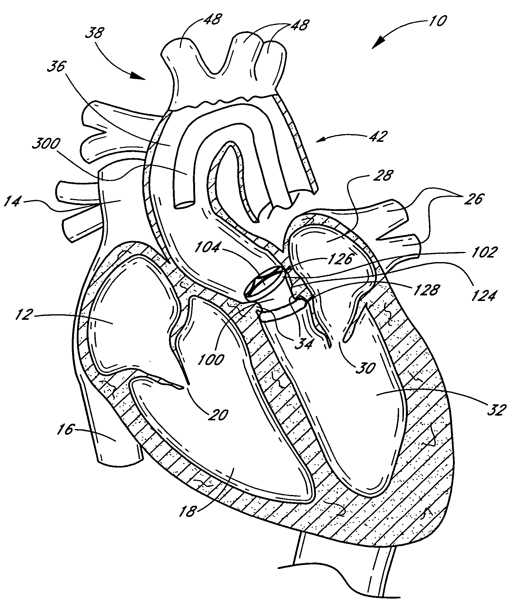 Methods of cardiac valve replacement using nonstented prosthetic valve