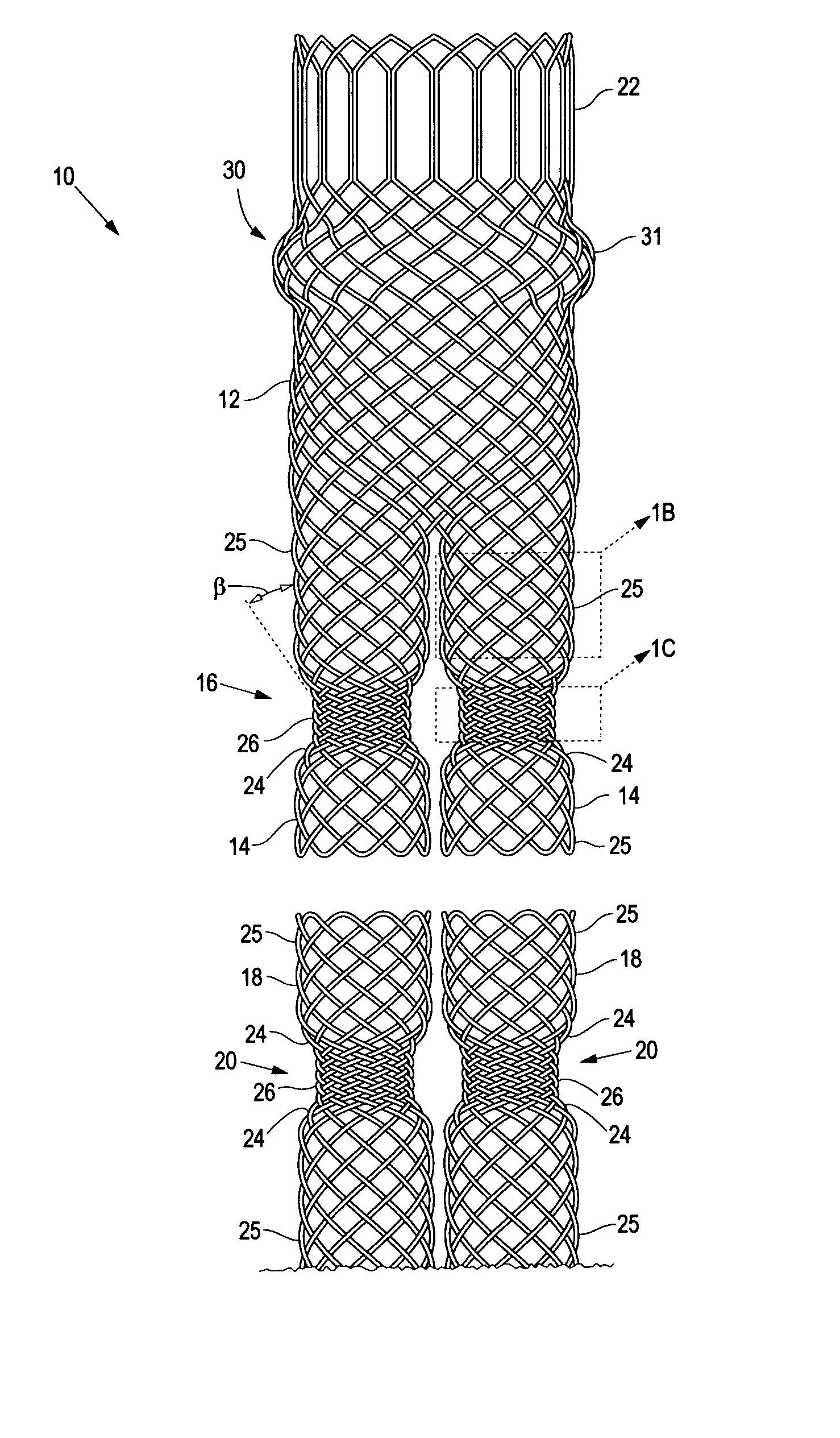 Braided modular stent with hourglass-shaped interfaces