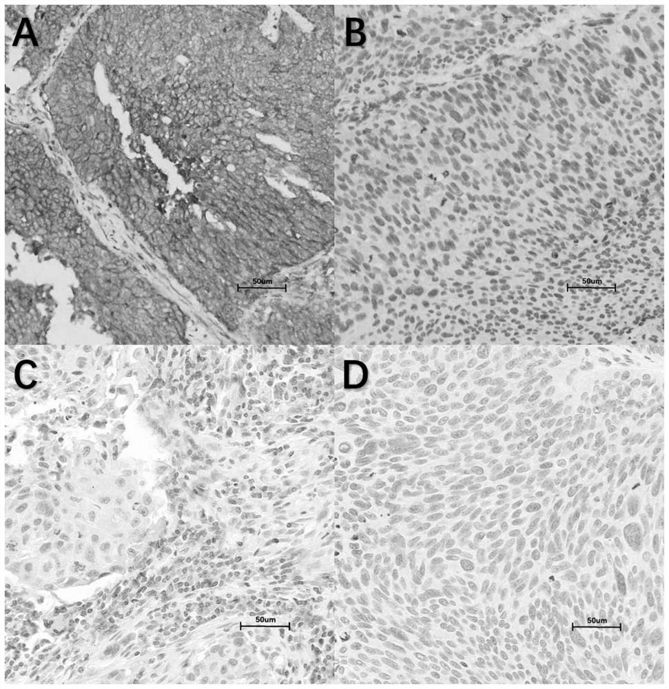 CD47 and TIGIT double-target-point-based lung squamous cell carcinoma patient prognosis evaluation system and application thereof