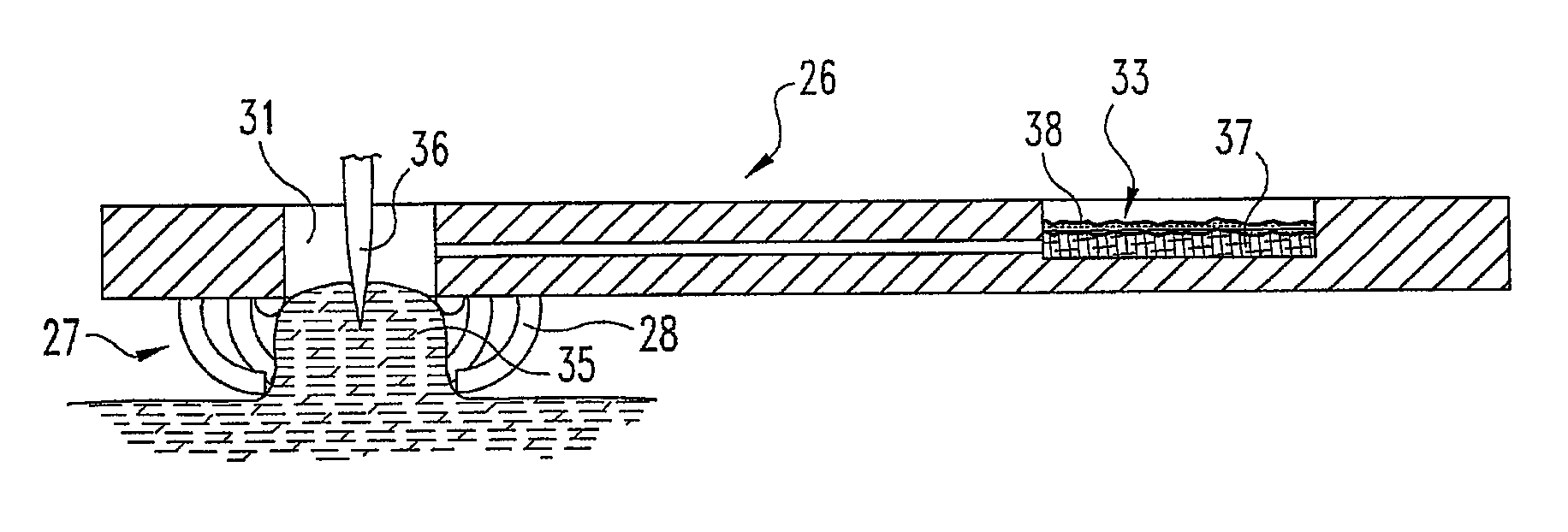 Devices and methods for expression of bodily fluids from an incision