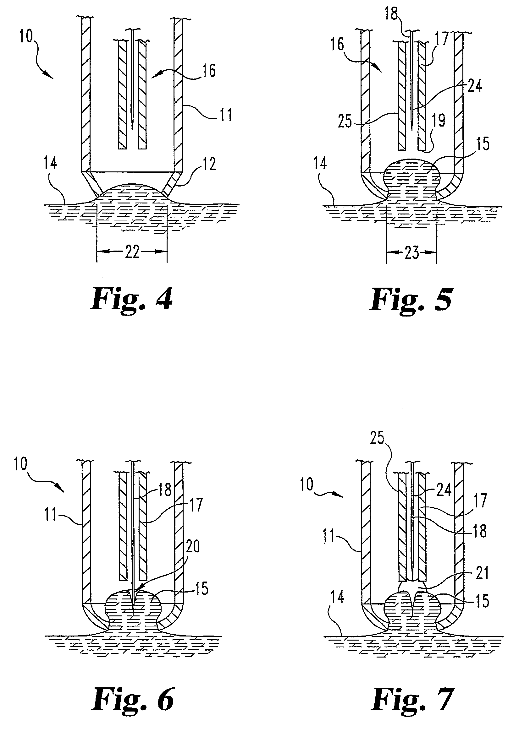 Devices and methods for expression of bodily fluids from an incision