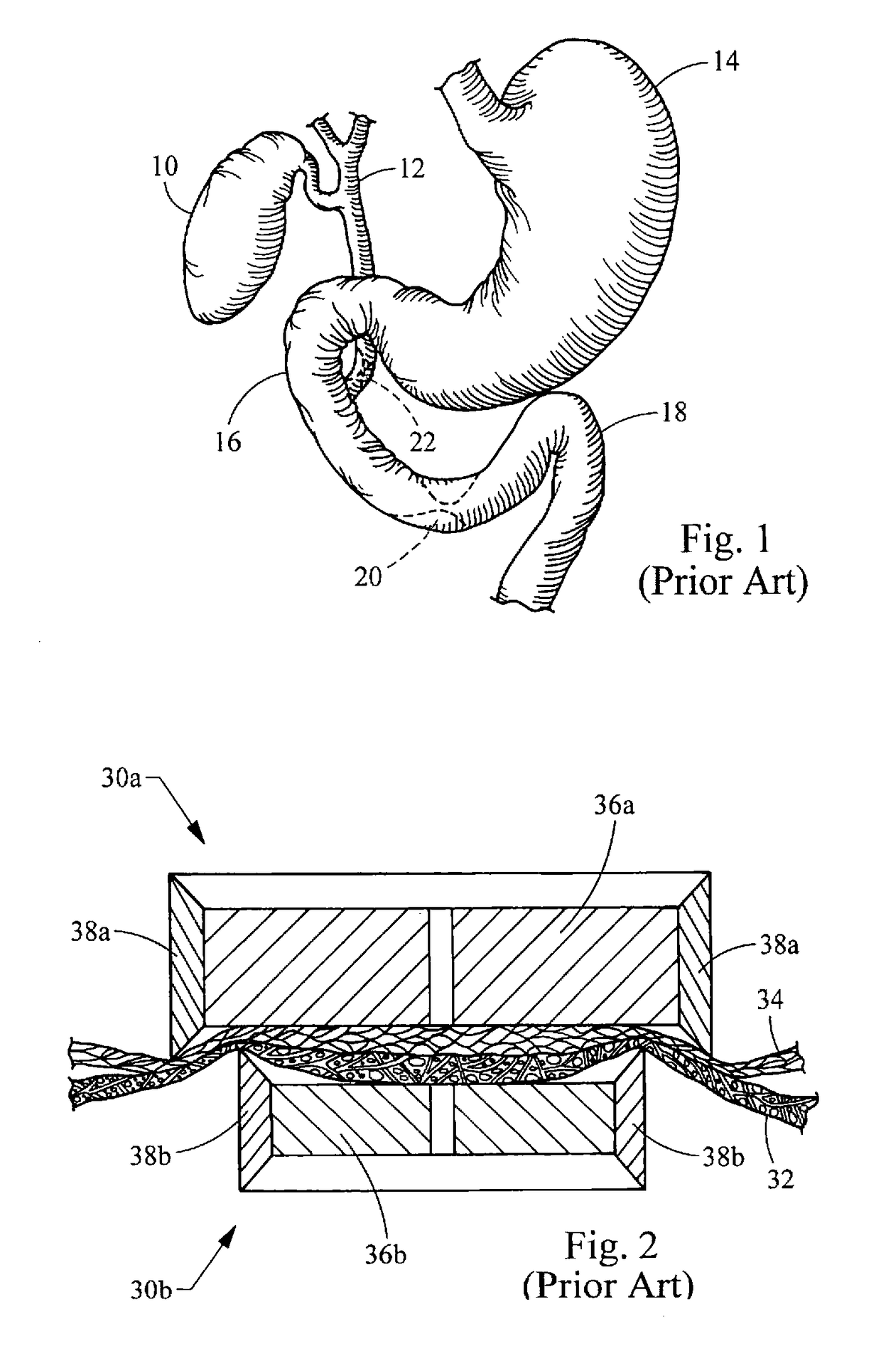 Magnetic anastomosis device having improved delivery