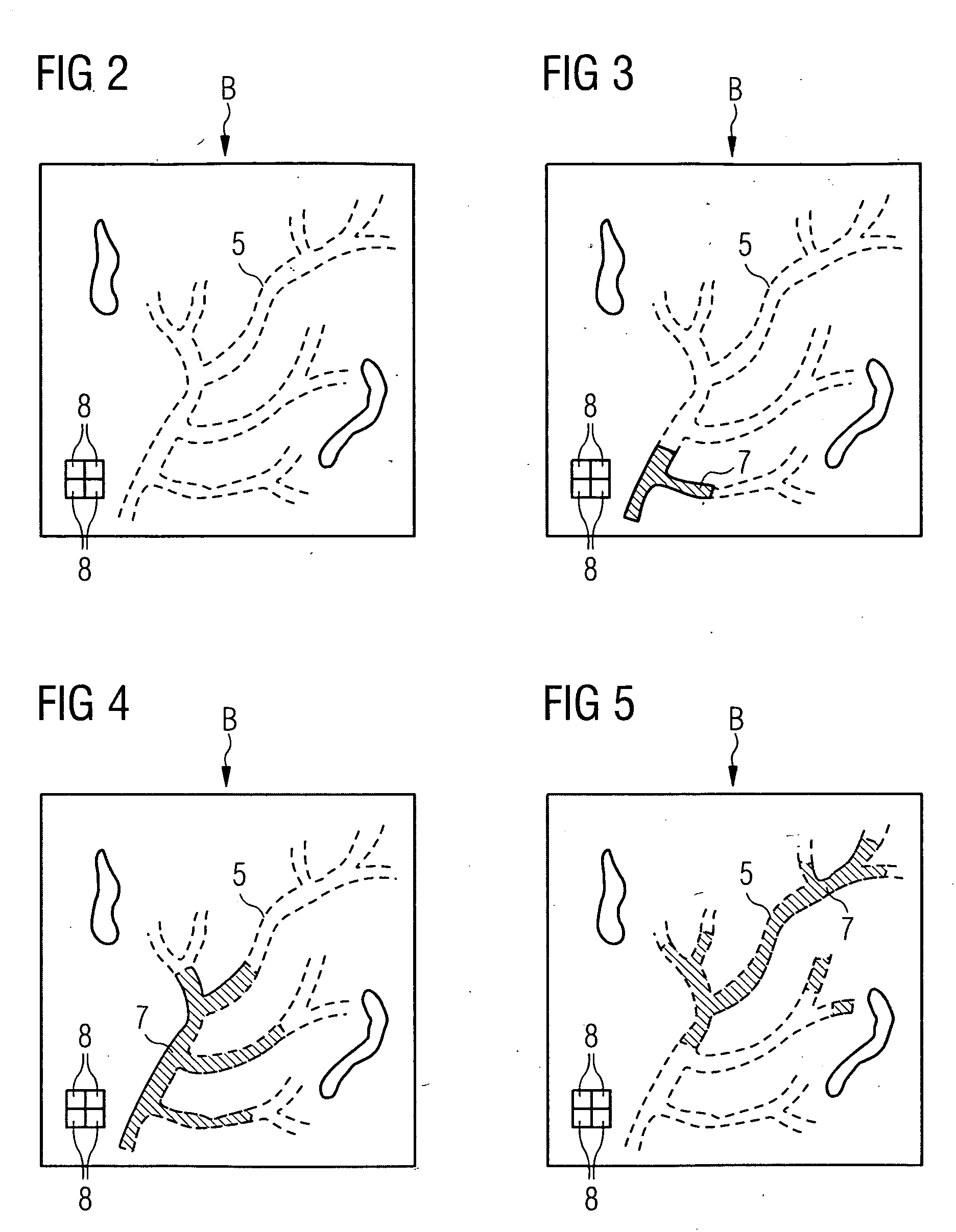 Registration method with three-dimensional representation of a vascular tree as a function of blood flow