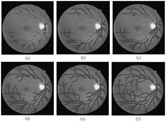 Eye fundus image vessel segmentation method based on local enhancement active contour module