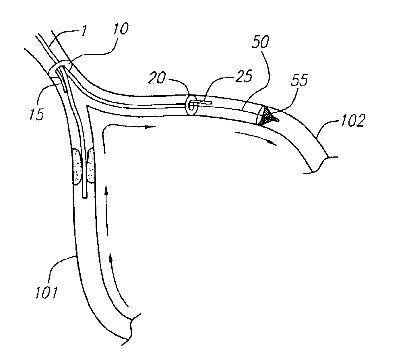 Devices and methods for preventing distal embolization using flow reversal in arteries having collateral blood flow