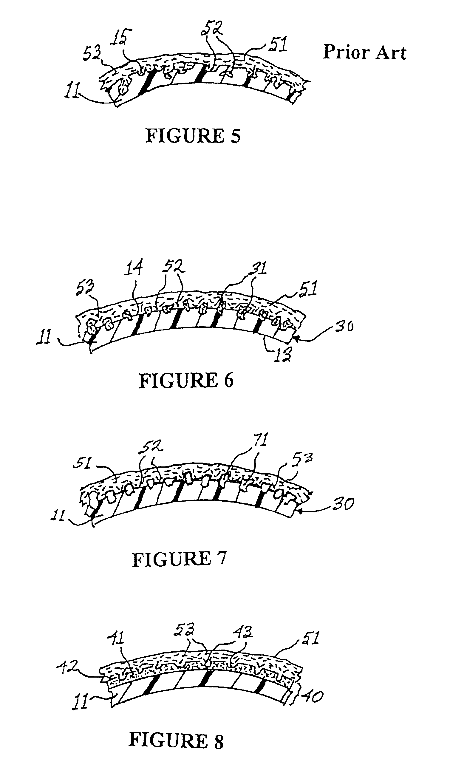 Medical implant having bioabsorbable textured surface