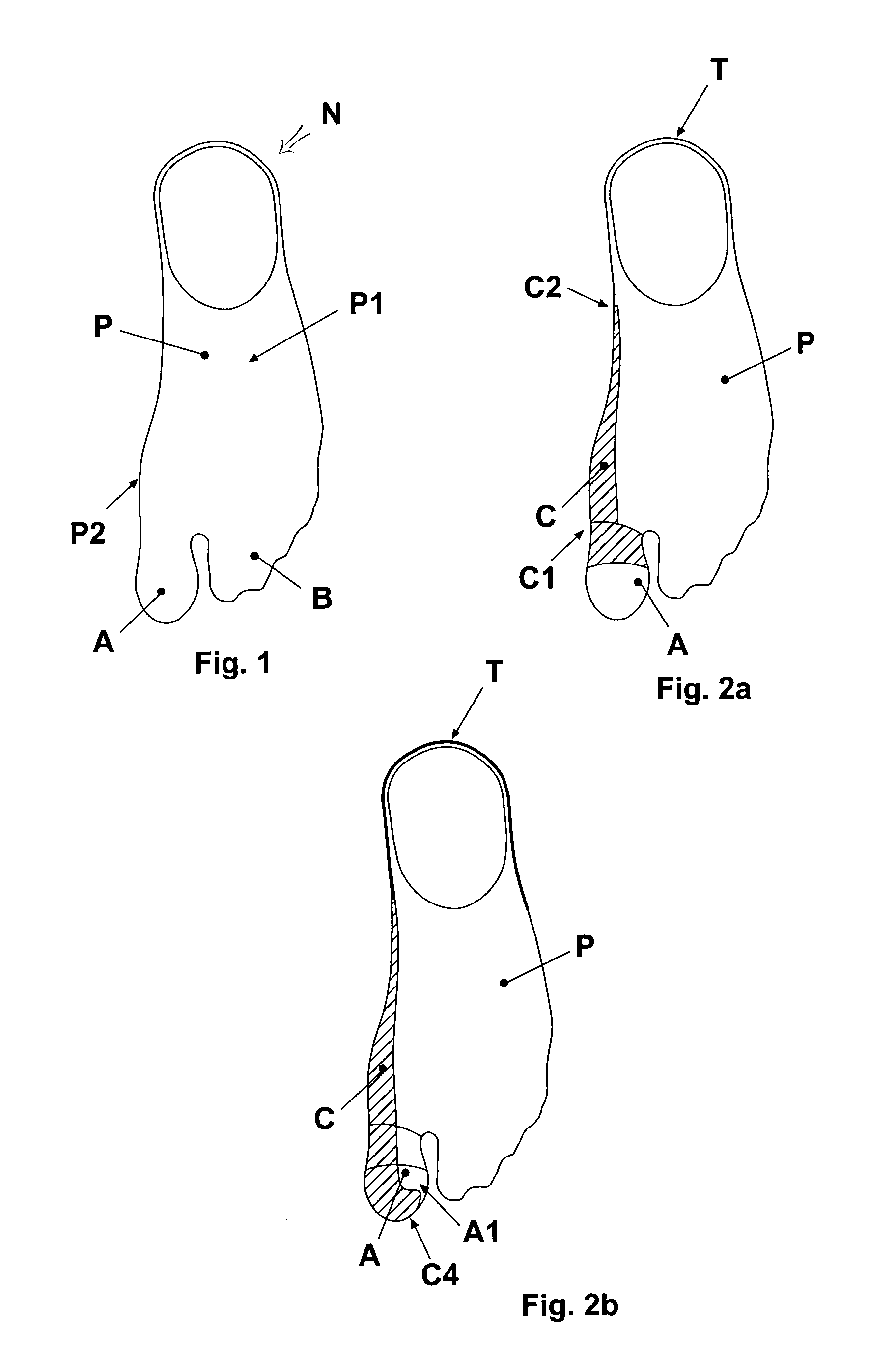 Reinforced stocking or sock for the prevention and/or treatment of hallux valgus