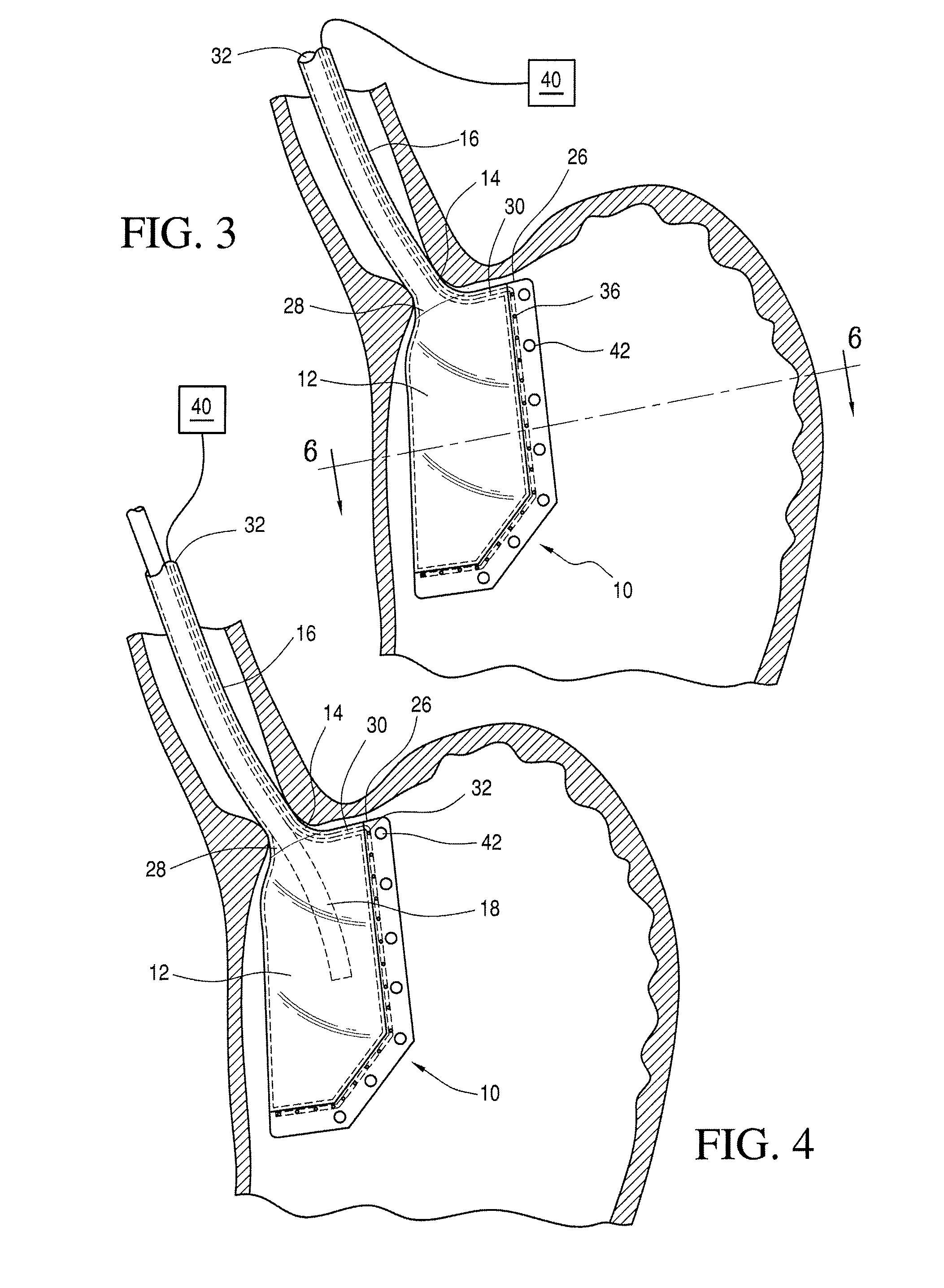 Method and apparatus for marking a lumenal wall