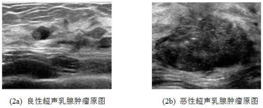 Automatic detection method of tiny calcifications based on ultrasound breast tumor images