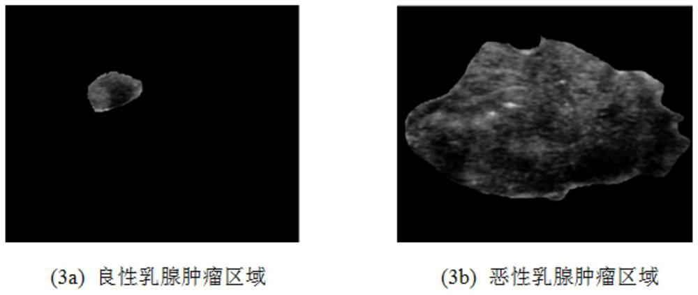 Automatic detection method of tiny calcifications based on ultrasound breast tumor images