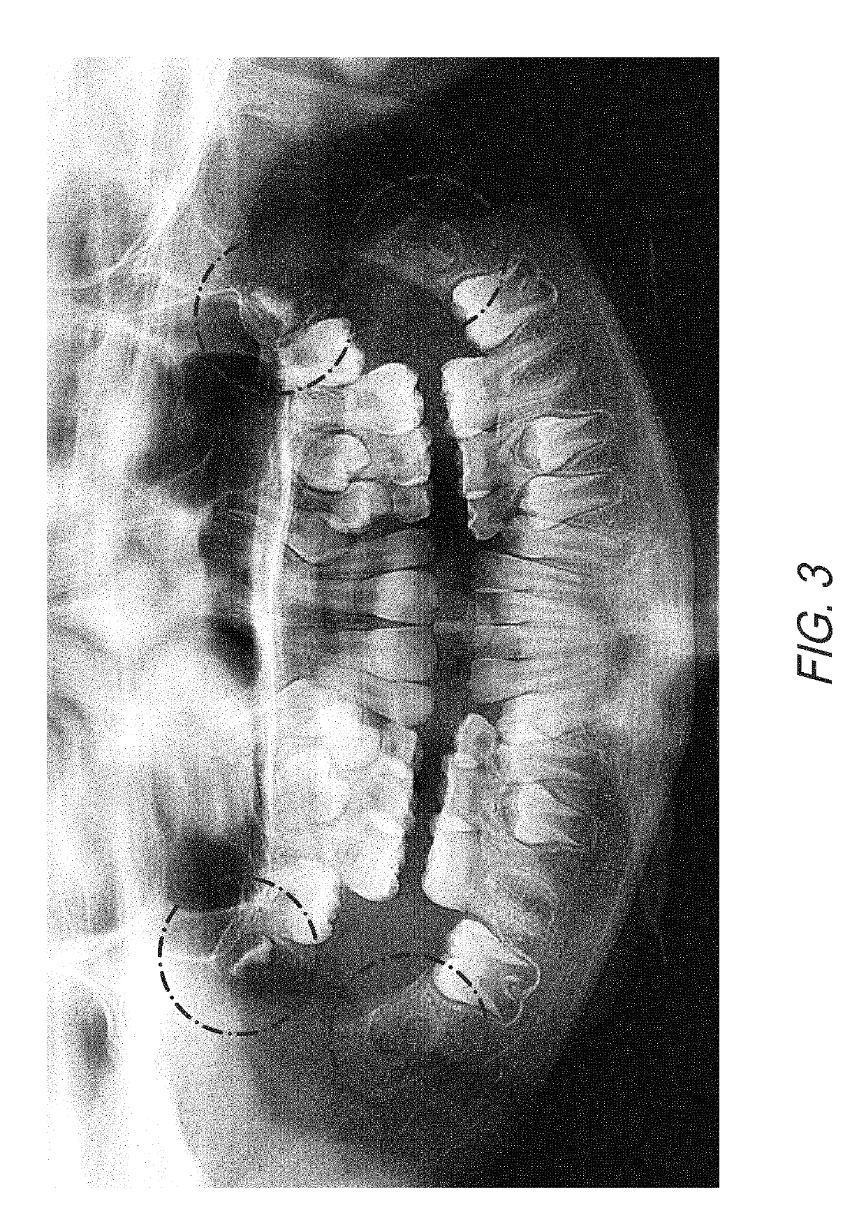 Therapeutic tooth bud ablation