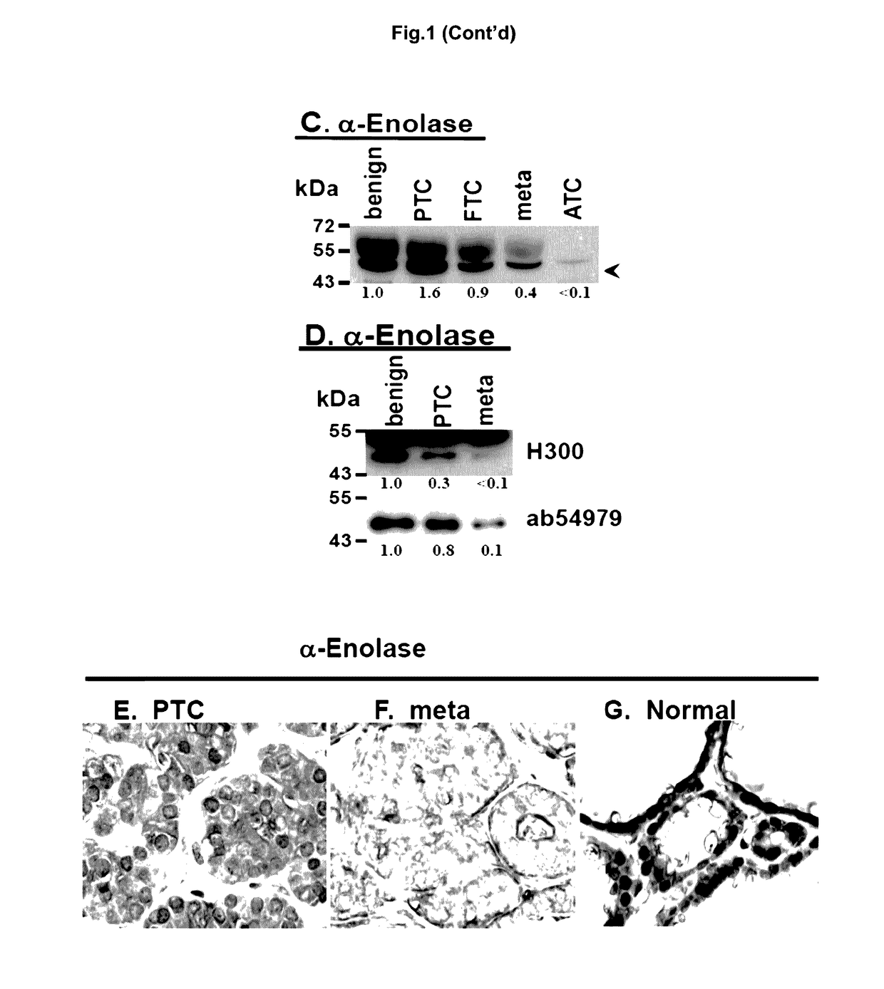 Method and Compositions for the Diagnosis of a Thyroid Condition