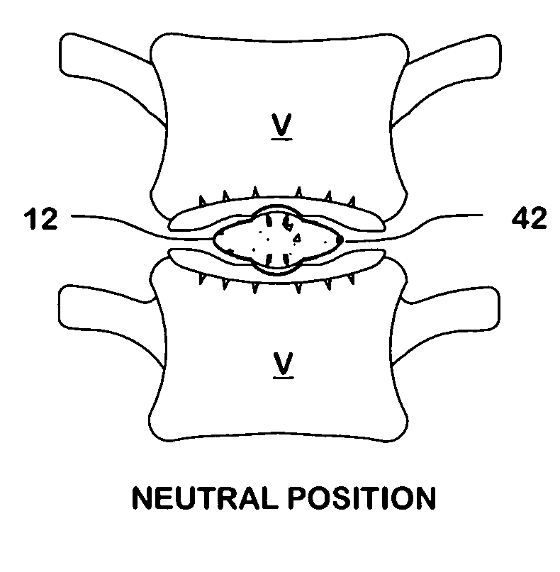 Inflatable intervertebral disc replacement prosthesis