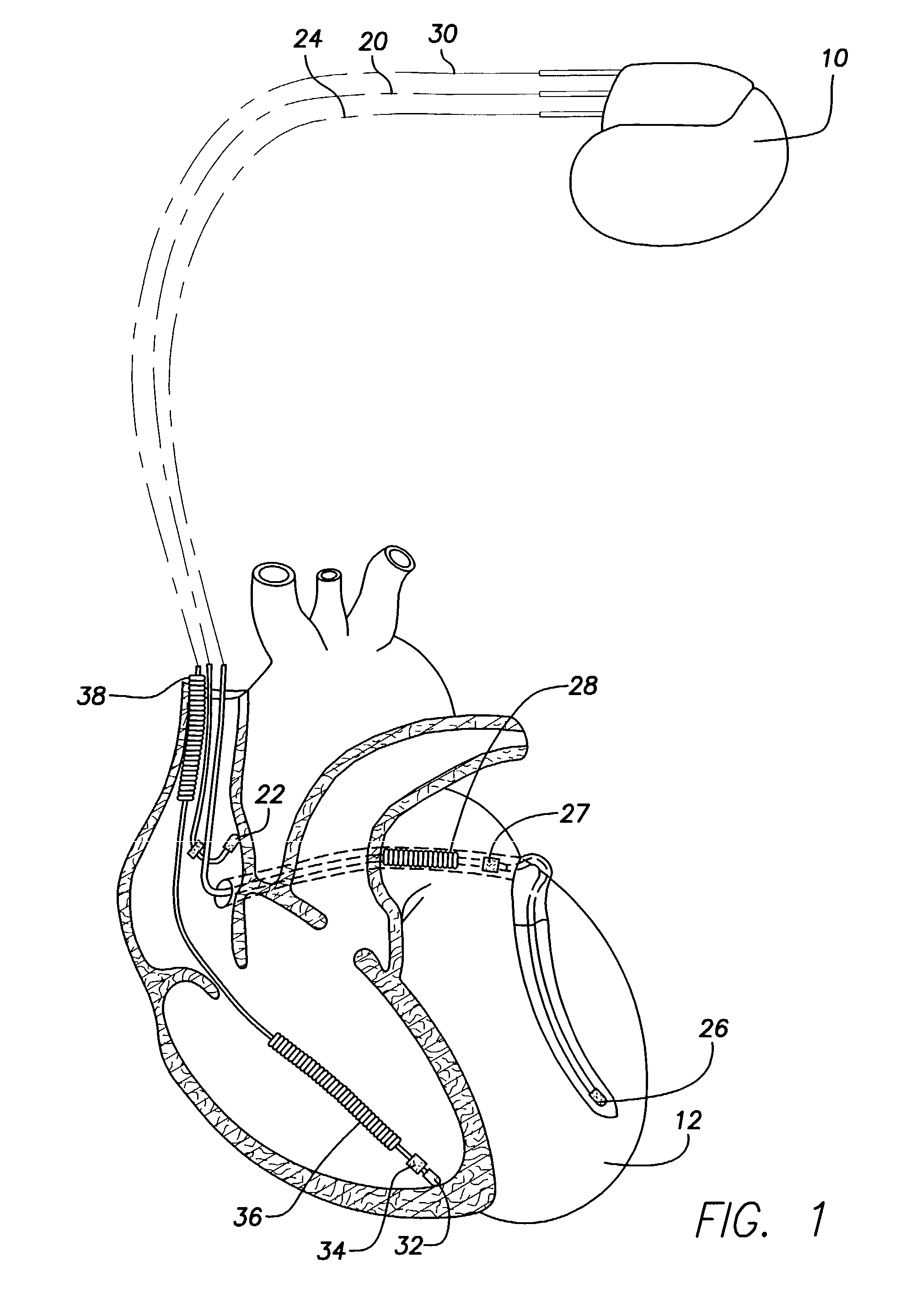 System and method for treating abnormal ventricular activation-recovery time