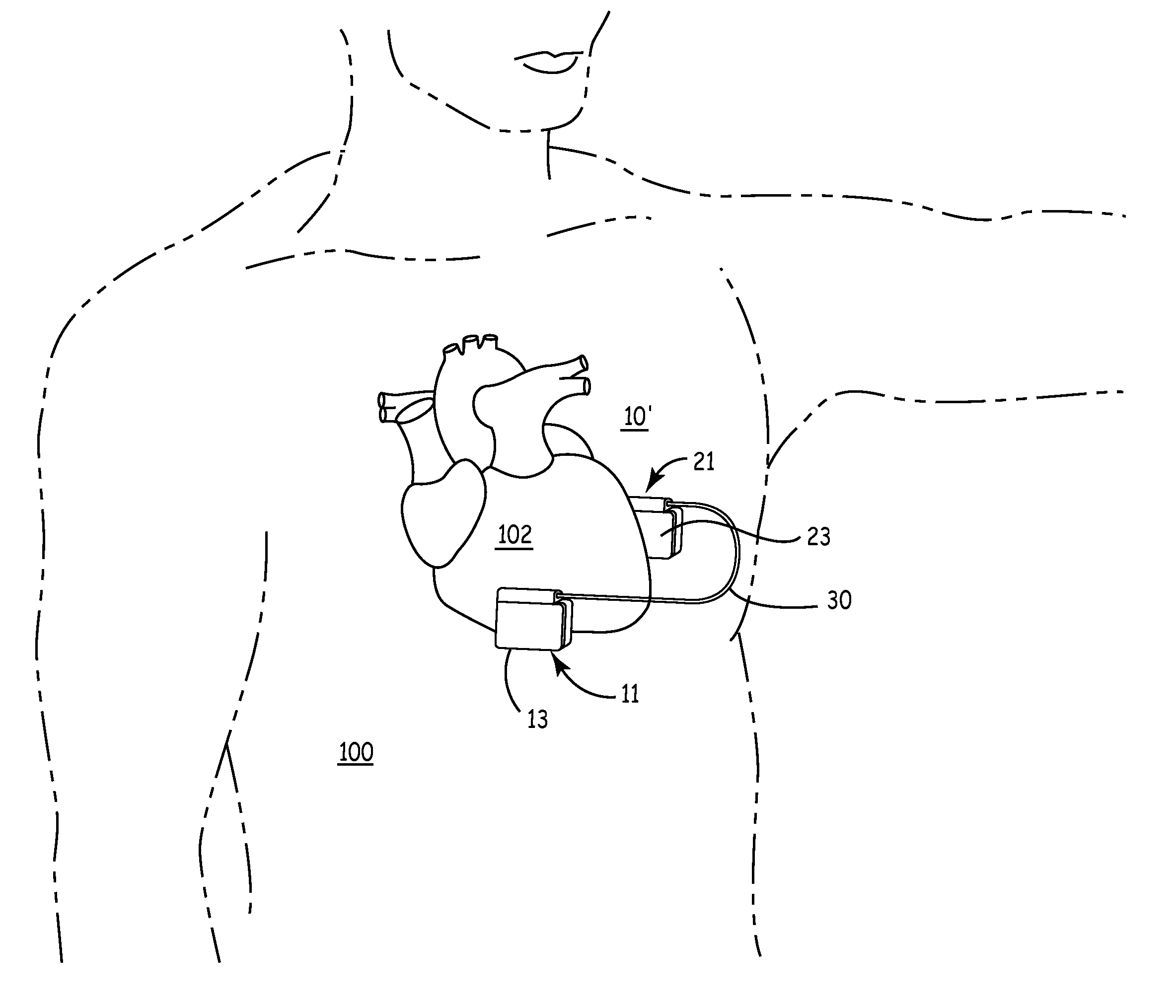Subcutaneous implantable cardioverter/defibrillator