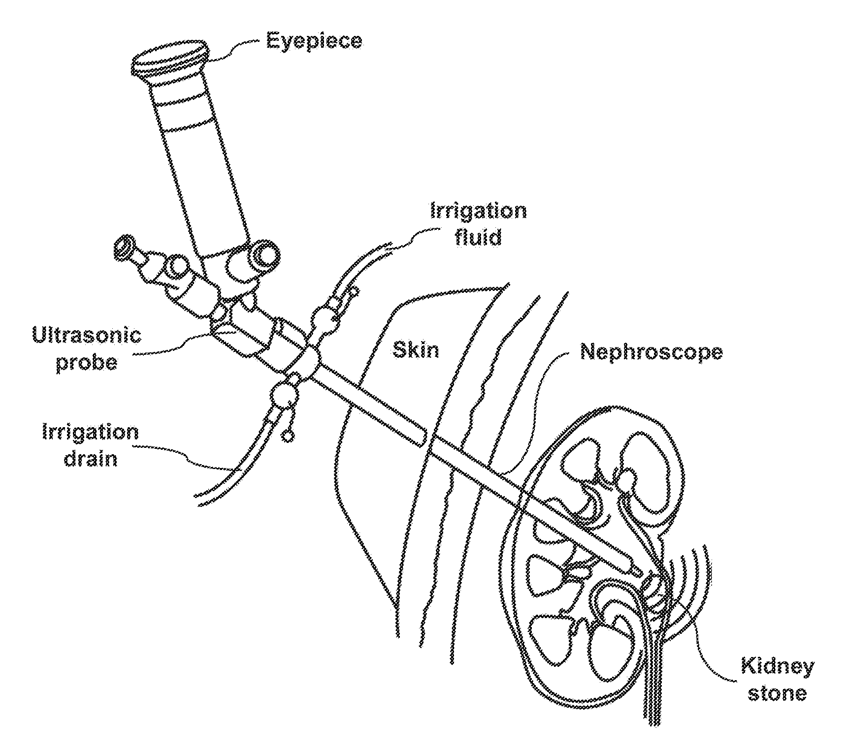 Method and System for Interactive 3D Scope Placement and Measurements for Kidney Stone Removal Procedure