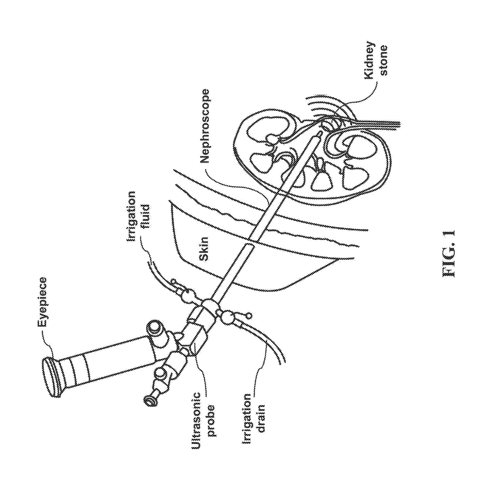 Method and System for Interactive 3D Scope Placement and Measurements for Kidney Stone Removal Procedure