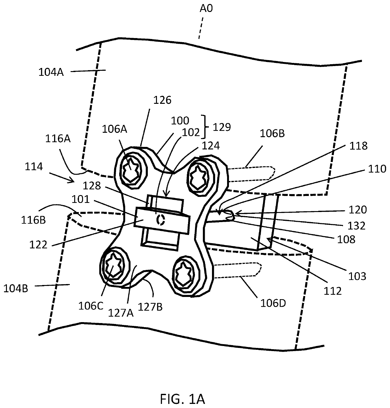 Placement jigs for osteosynthesis systems and related methods